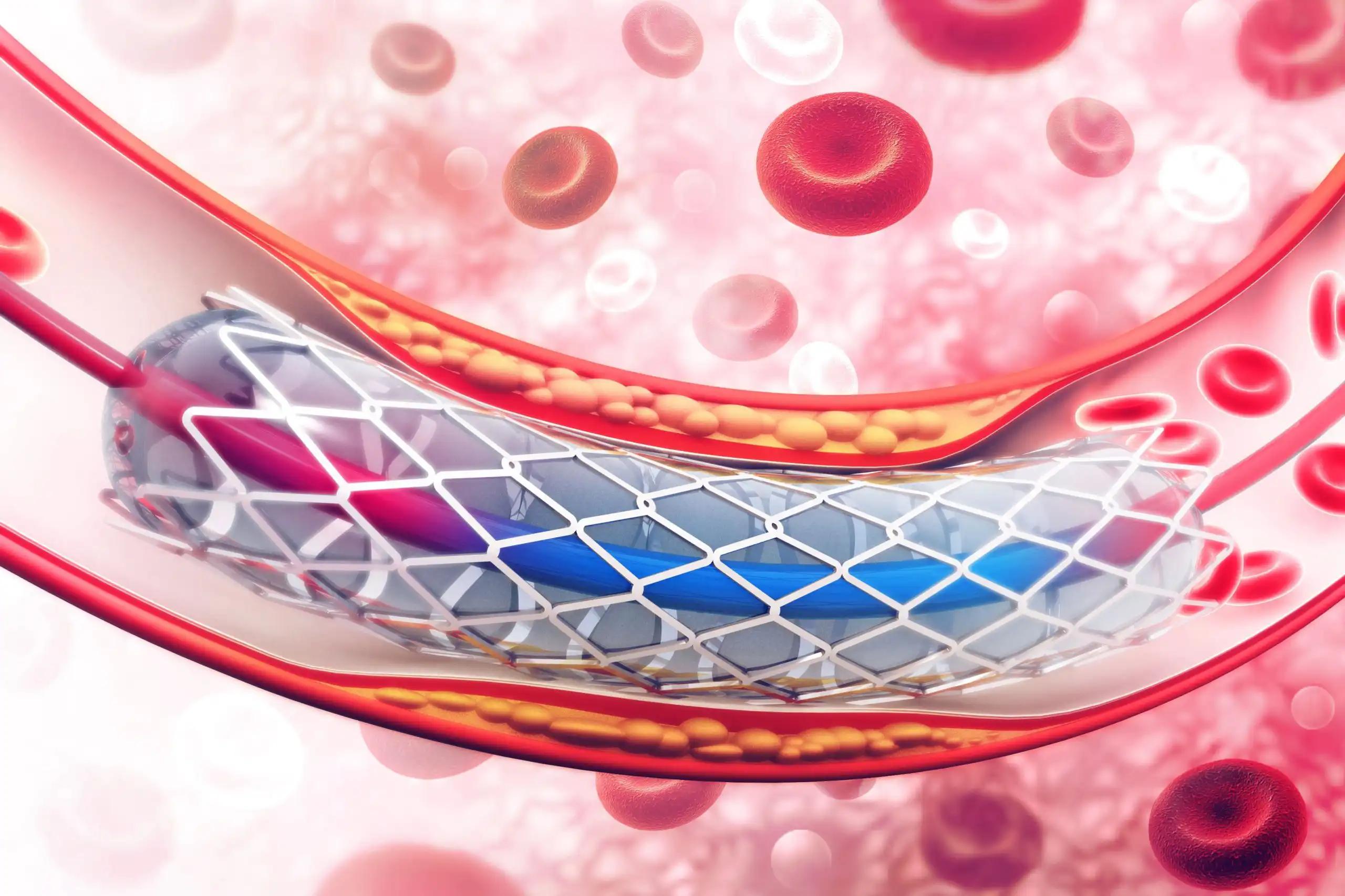 3d illustration of Angioplasty with Stent 