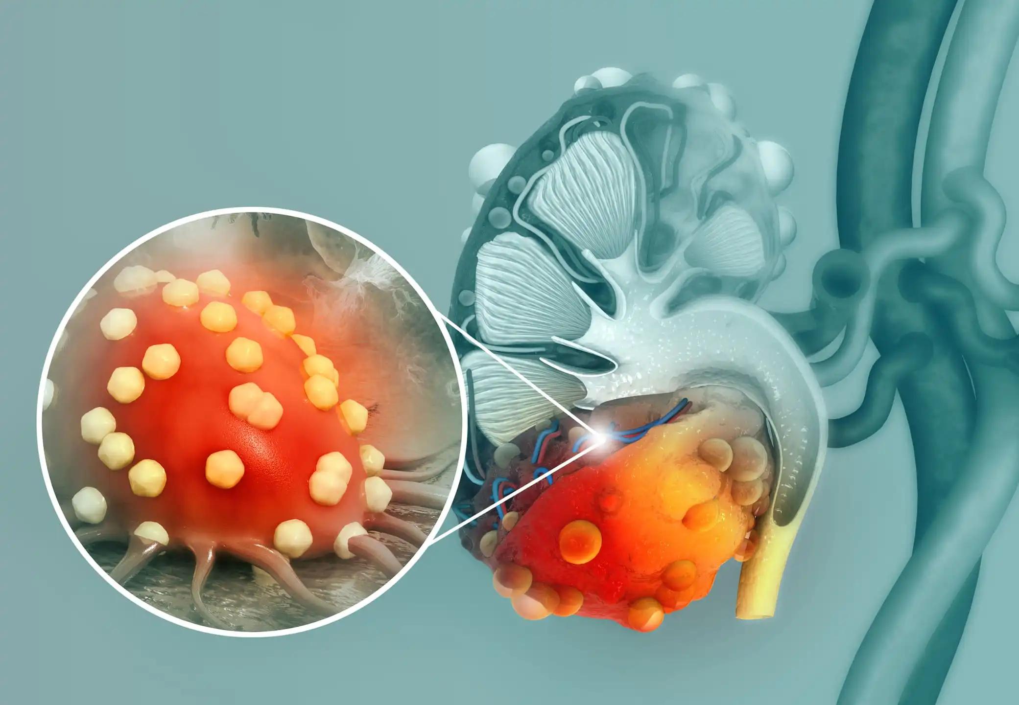 3d illustration of Kidney Viral Infection