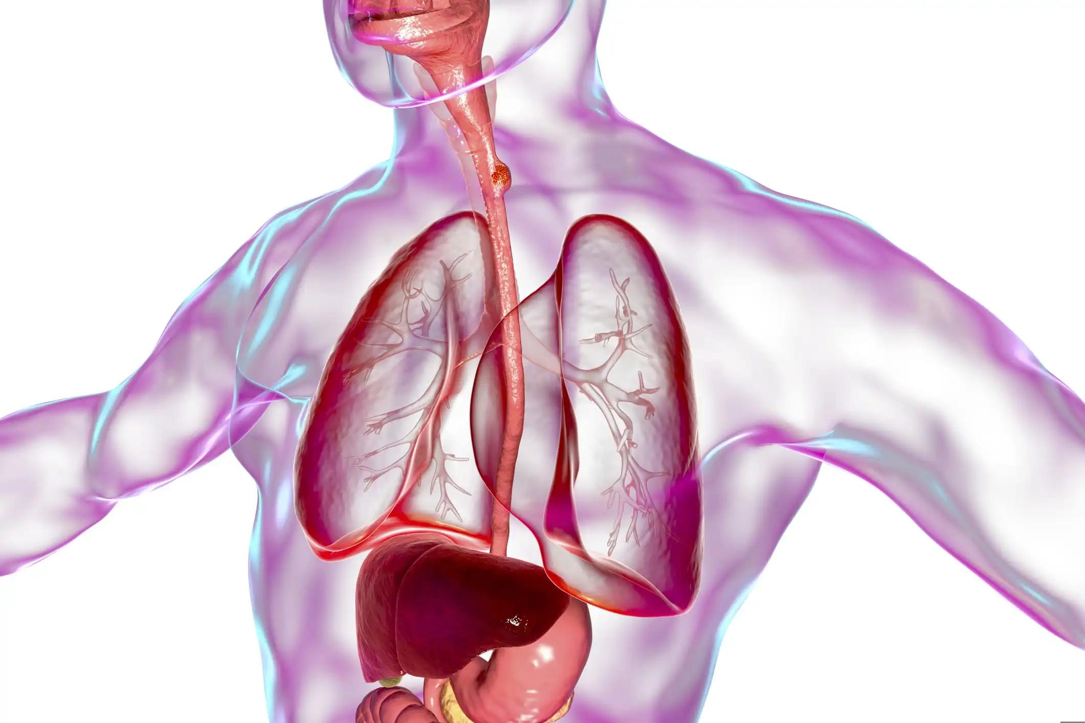 3D illustration Showing Malignant Tumor Human Esophagus