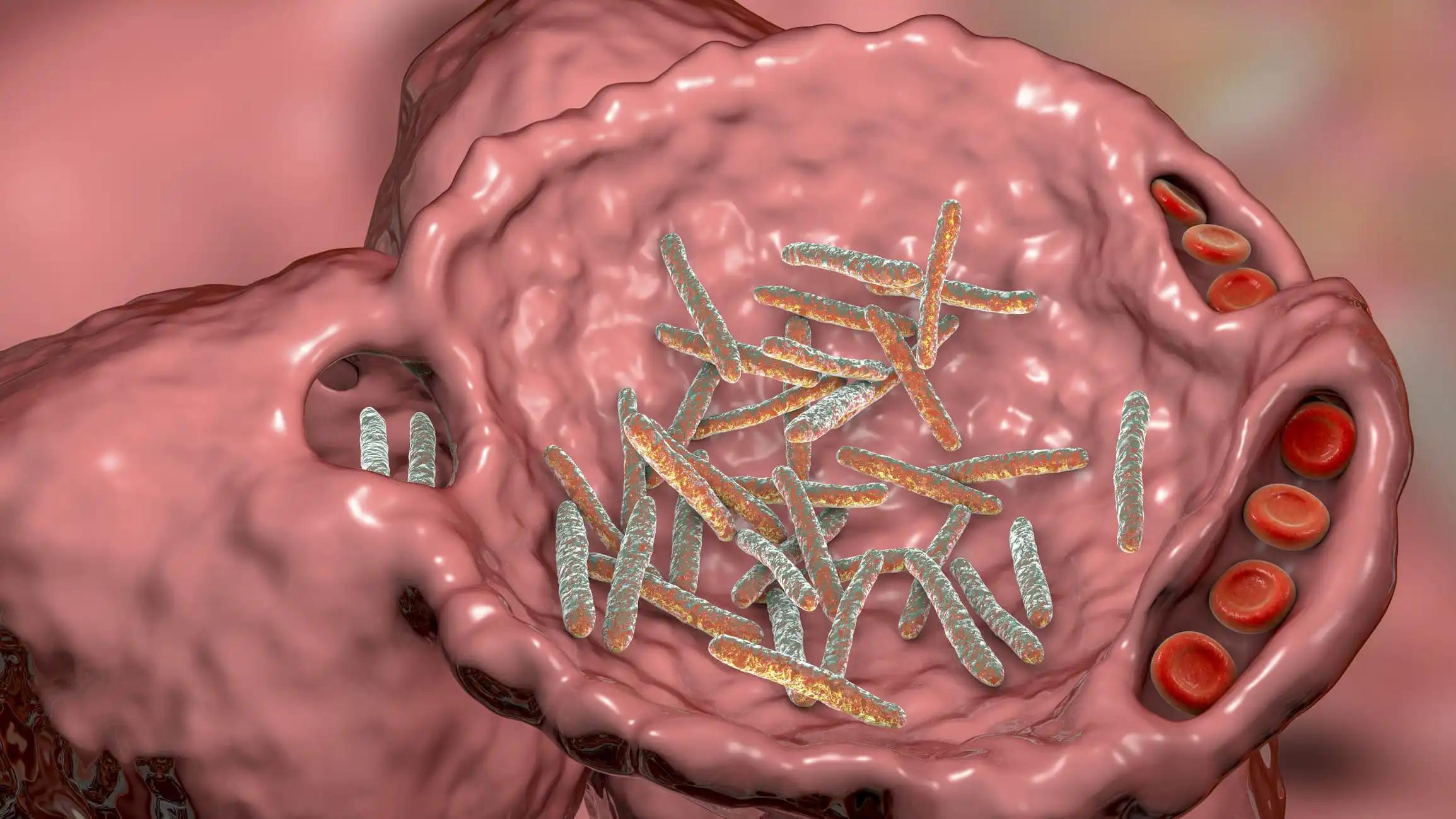 3D View Bacterial Pneumonia