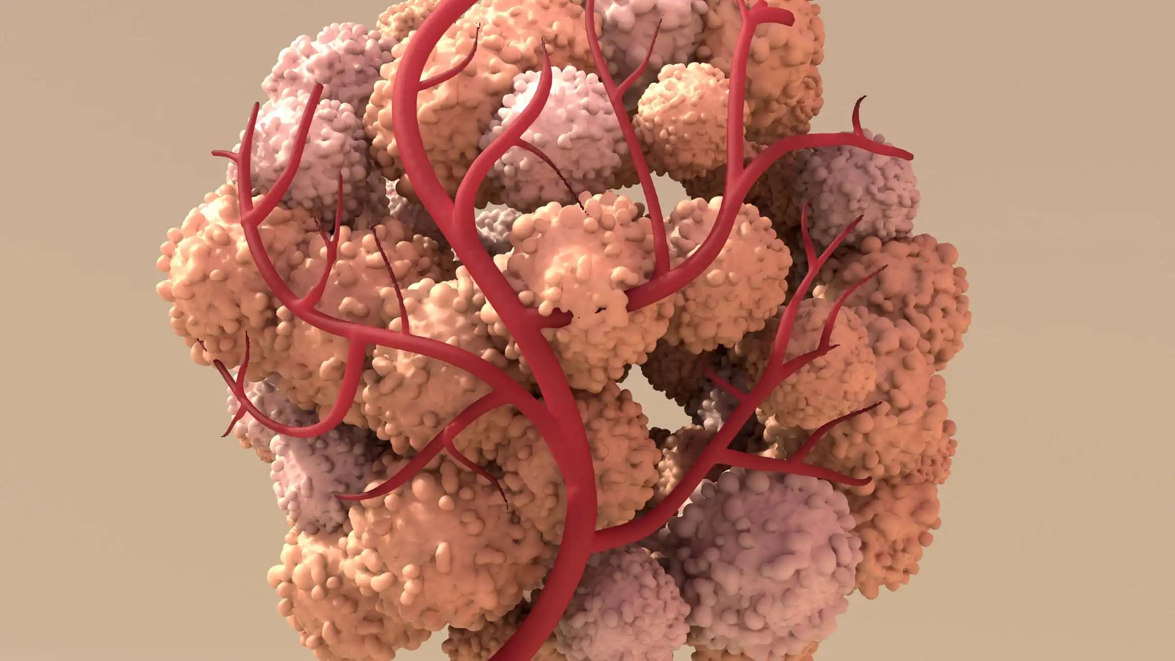 3D View of Tumor Abnormal Mass of Tissue