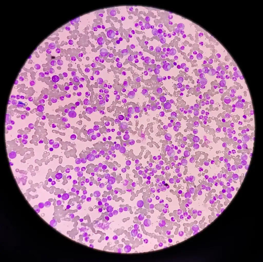 Blood Cancer Chronic Myelogenous Leukemia Cells