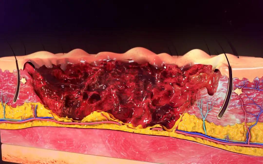 Sonidegib Treatment in laBCC: Clinical Response Associations