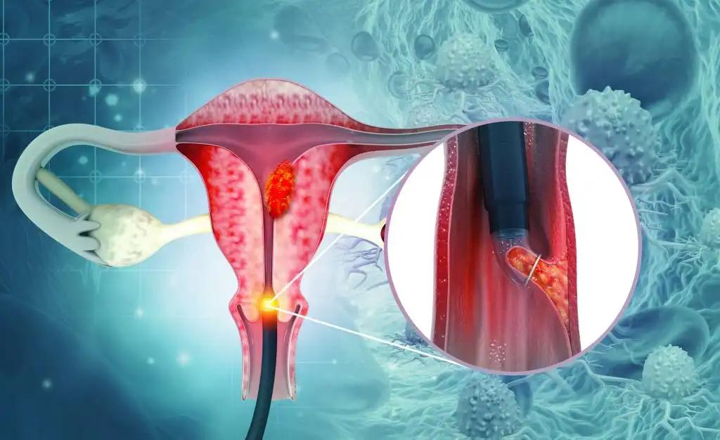 Immunotherapy Recommended for Advanced Cervical Cancer