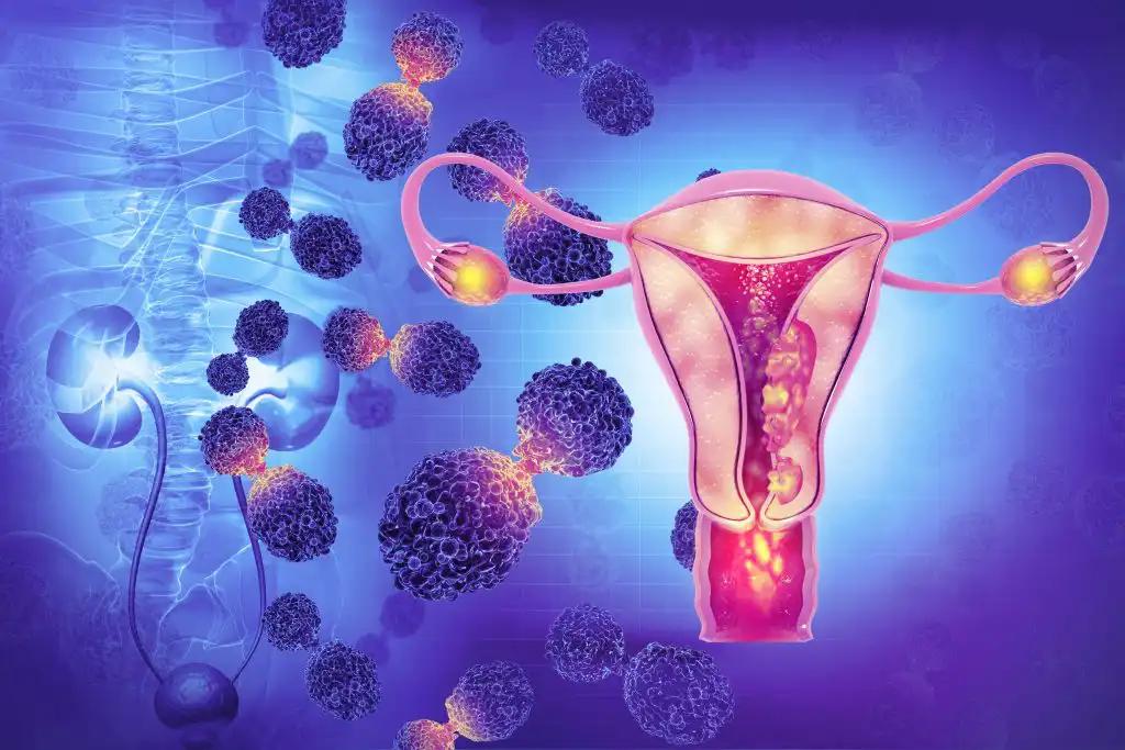 3d illustration Endometrial Malignant Tumor