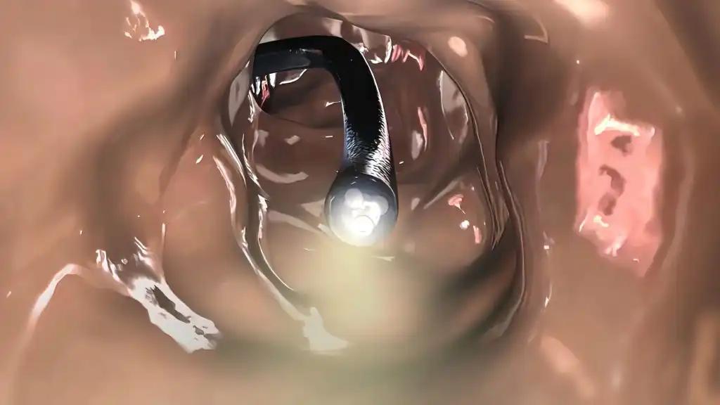 Colonoscopy Biopsy Of The Gastrointestinal Tract
