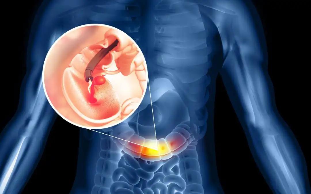 Evaluating TROP2 as a Prognostic Marker in CRC