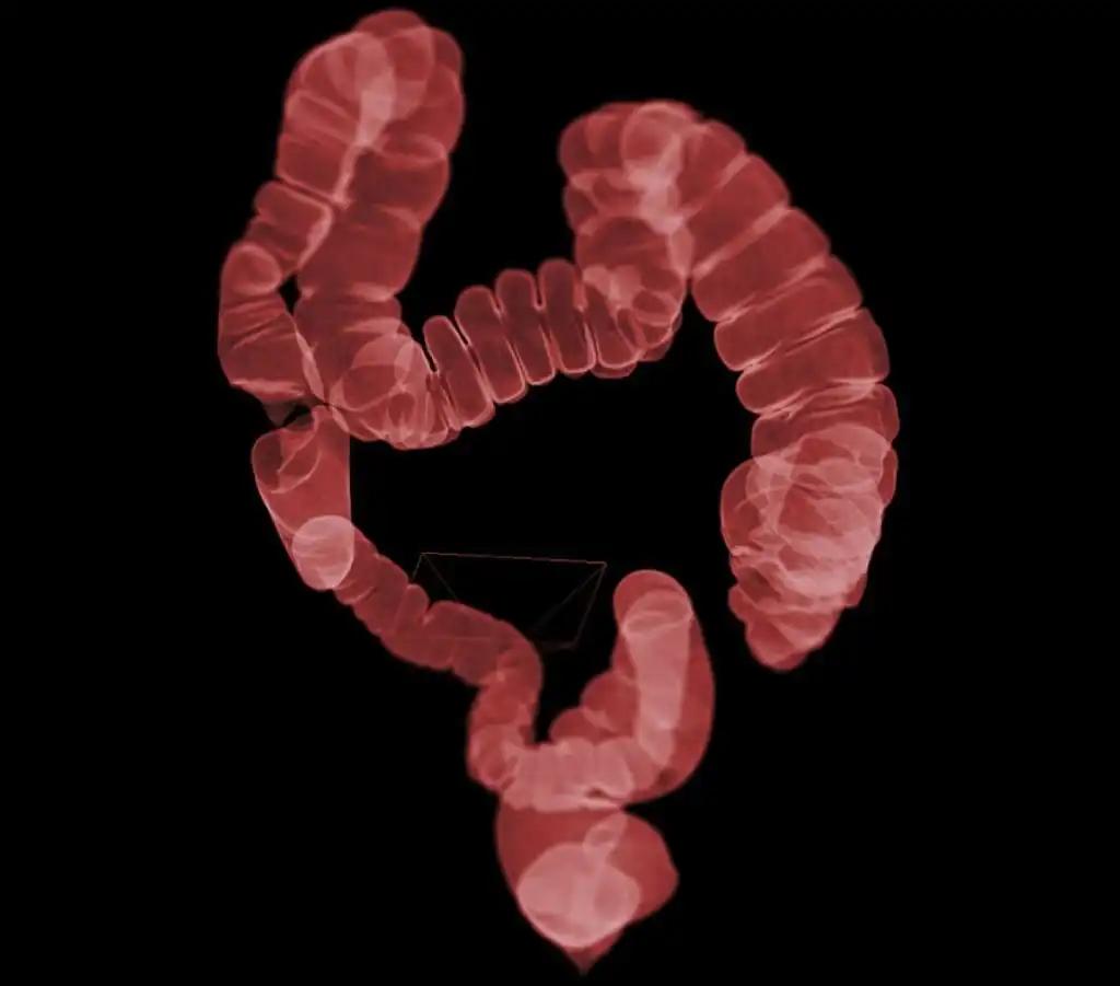 CT Colonography for Colorectal Cancer