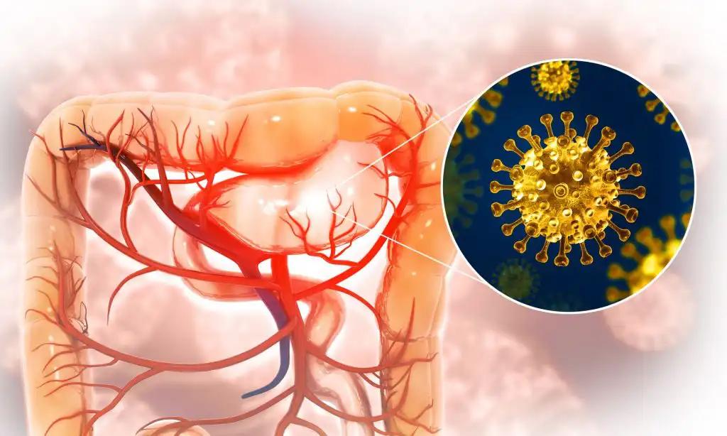 Advanced Colorectal Cancer Cell