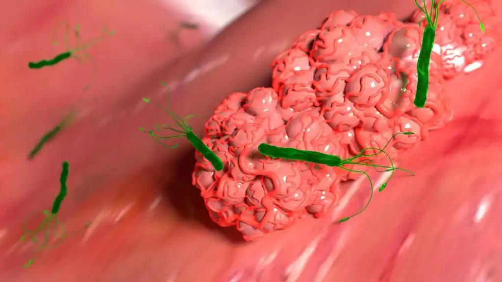 Close Up View of Tumor in Pancreatic Cancer