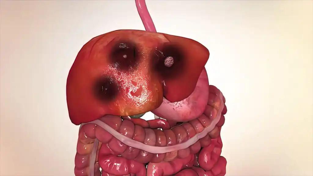 Pancreatic Cancer on Stomach