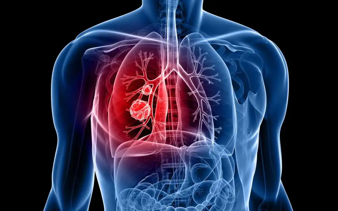 Atezolizumab Boosts Survival for Smokers With High PD-L1 NSCLC