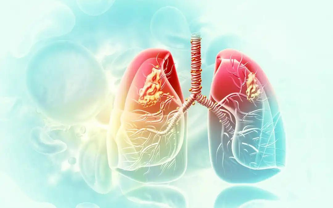 Clinical Outcomes with High-Dose Once-Daily Thoracic Radiotherapy