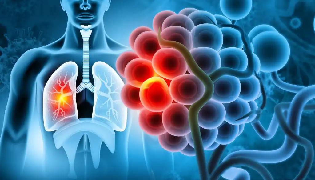 Early Detection of Lung Cancer 3D View