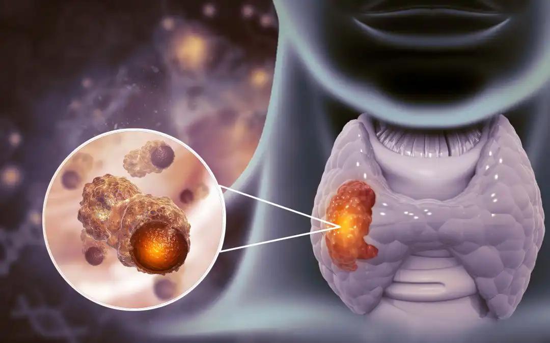 Evaluating TME Impact on Postoperative RF