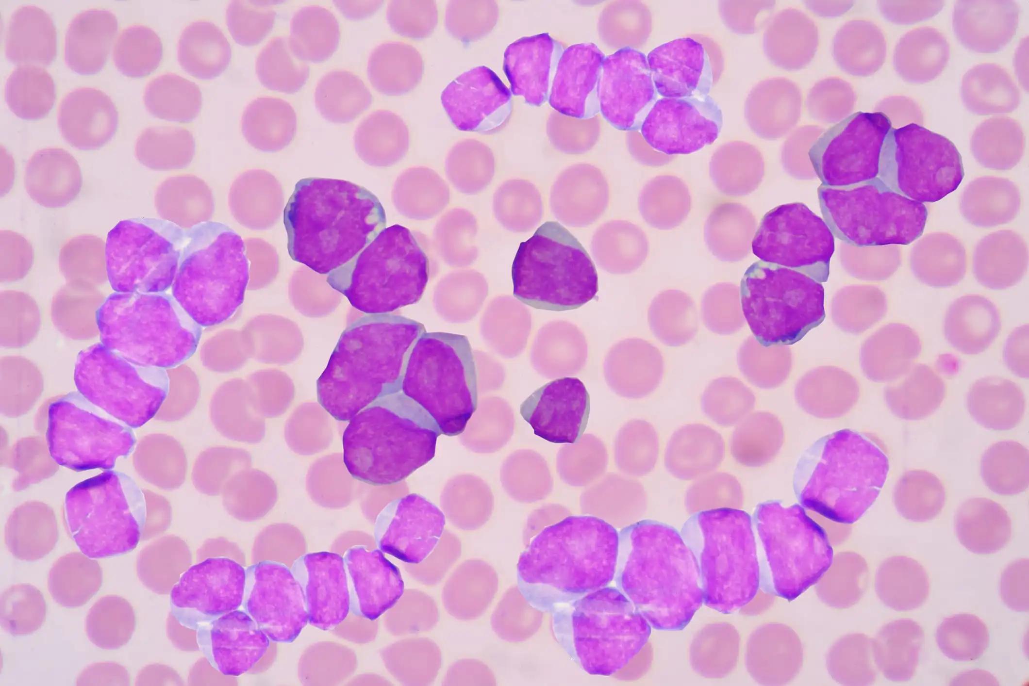 Acute Myelogenous Leukemia Cells