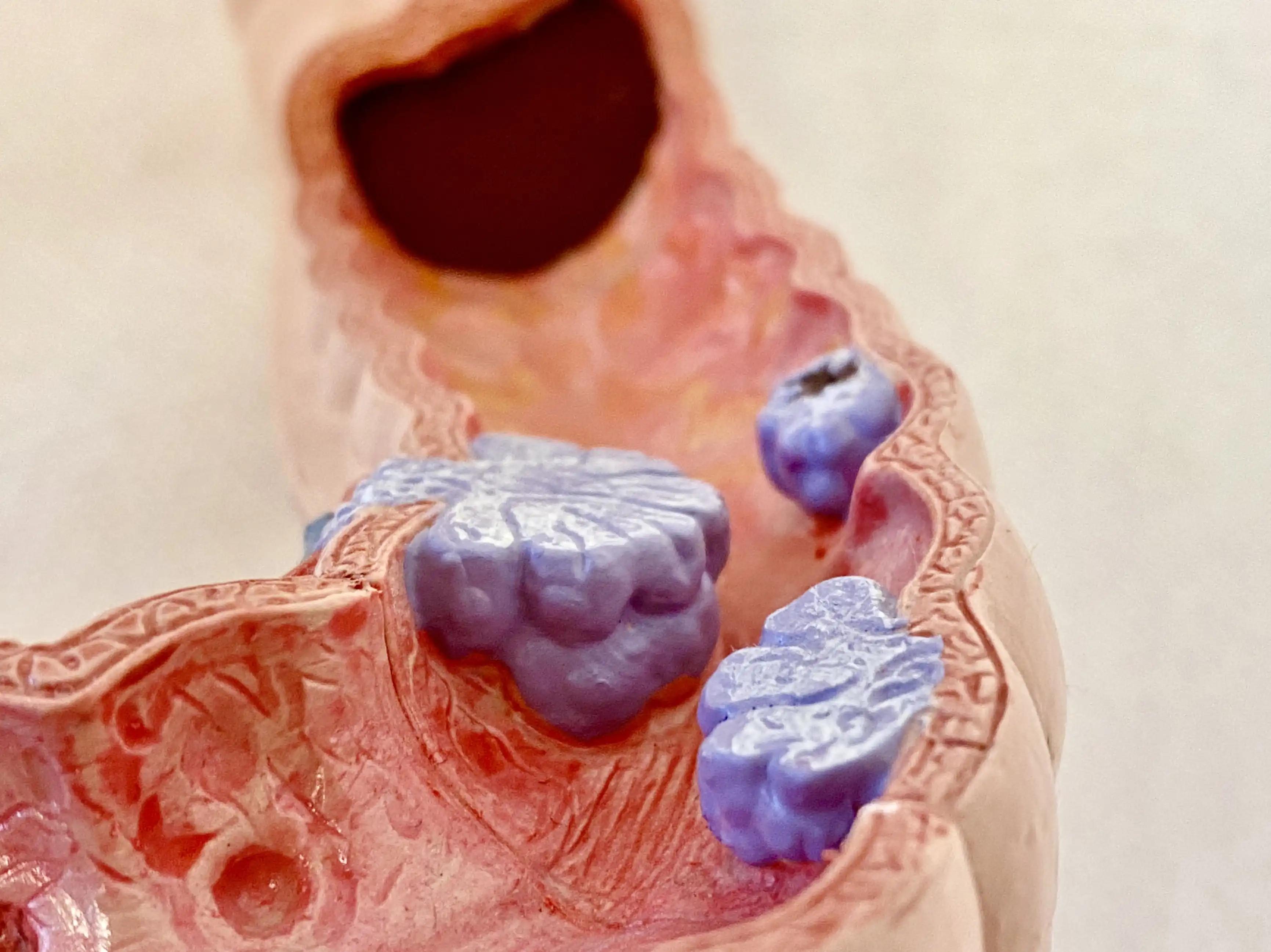 Anatomical Model of Colon Cancer