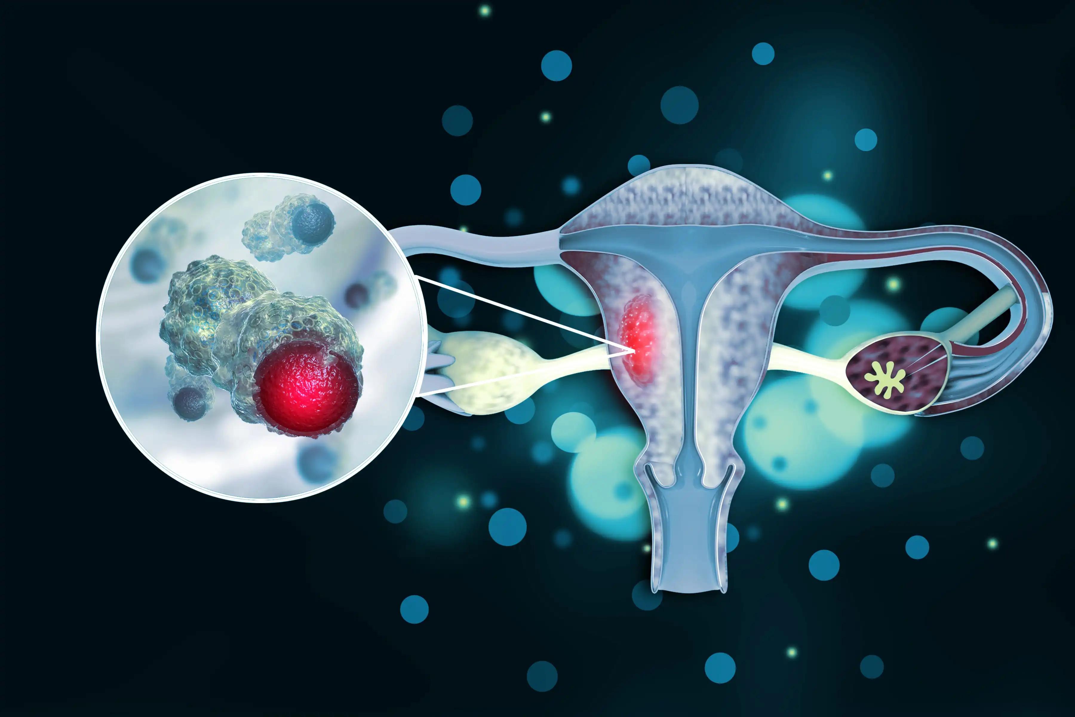 Bacteria Infection in Endometrial Cancer