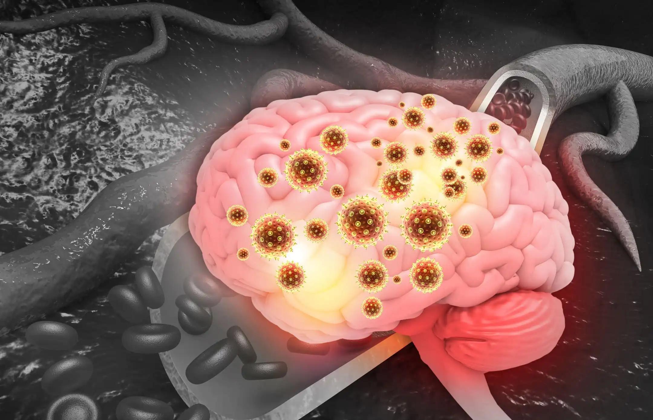 Bacterial Meningitis Brain 3D
