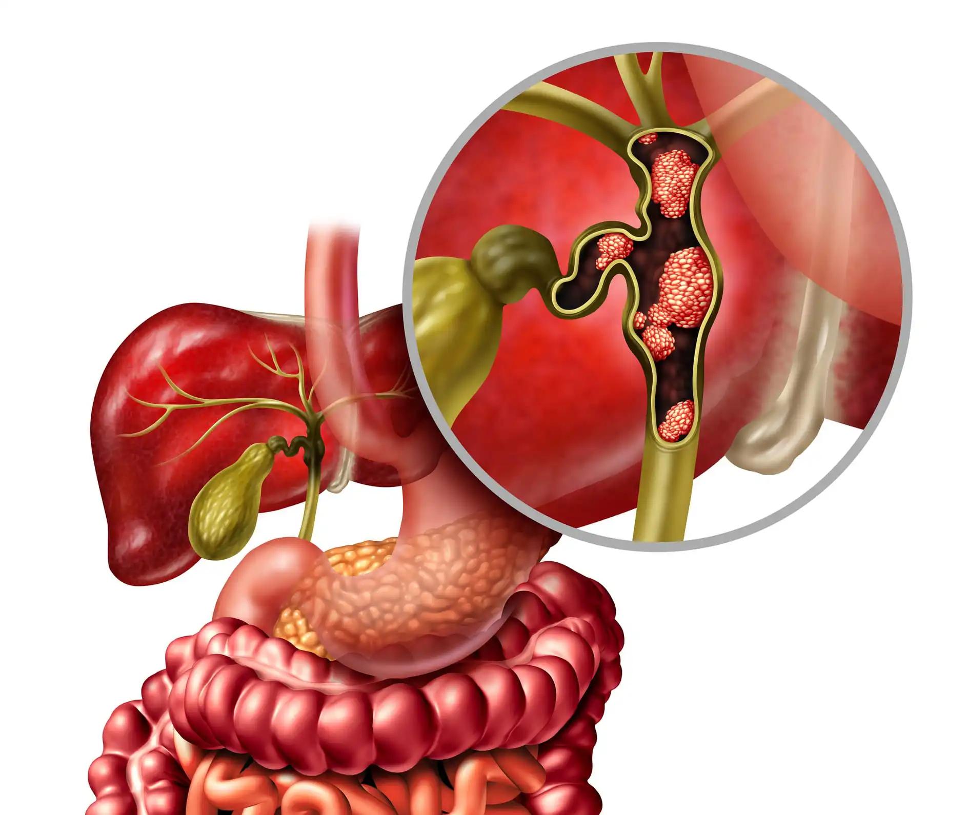 Bile Duct Cancer with Gallbladder and Liver