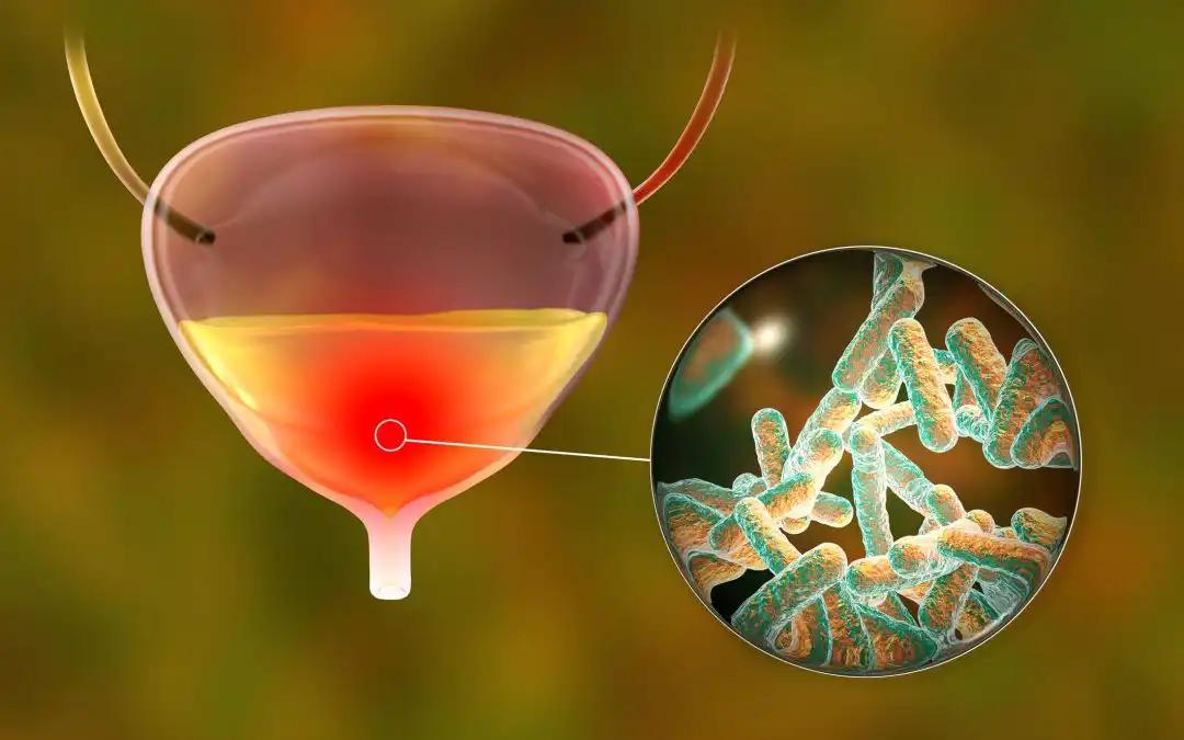 CDK6: A Prognostic Biomarker in Bladder Cancer