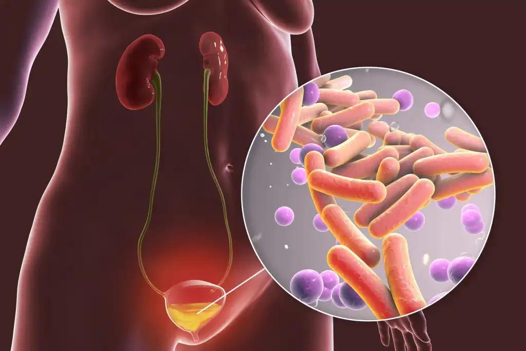 Cancer Bcterial Infection in Urinary Bladder