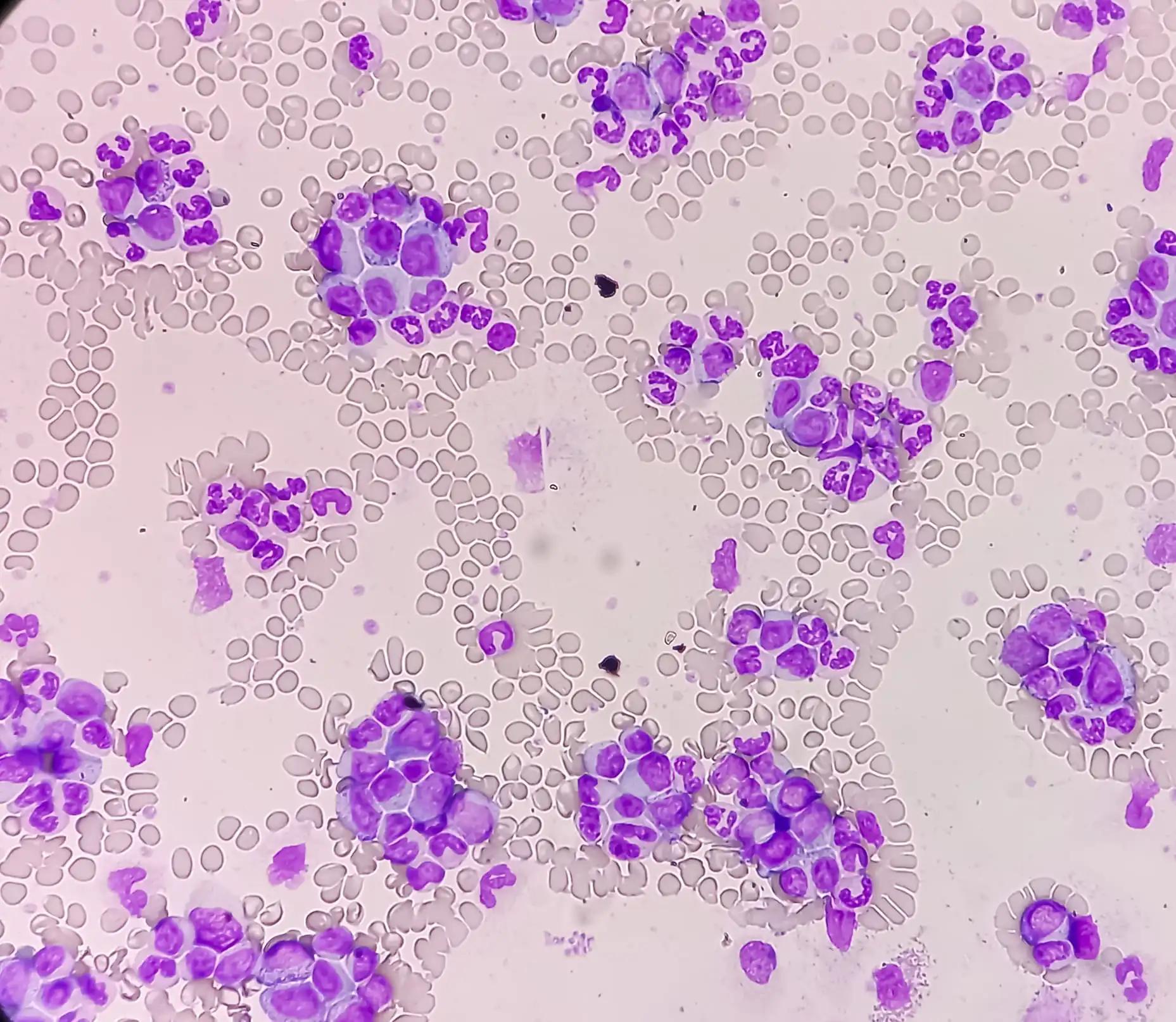 Chronic Myelogenous Leukemia White Blood Cells