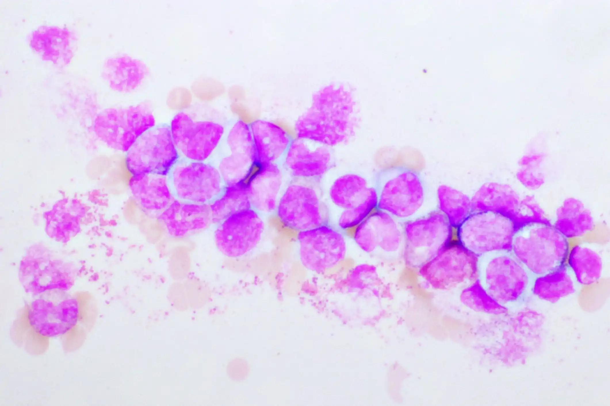 Chronic Myeloid Leukemia Cells or CML