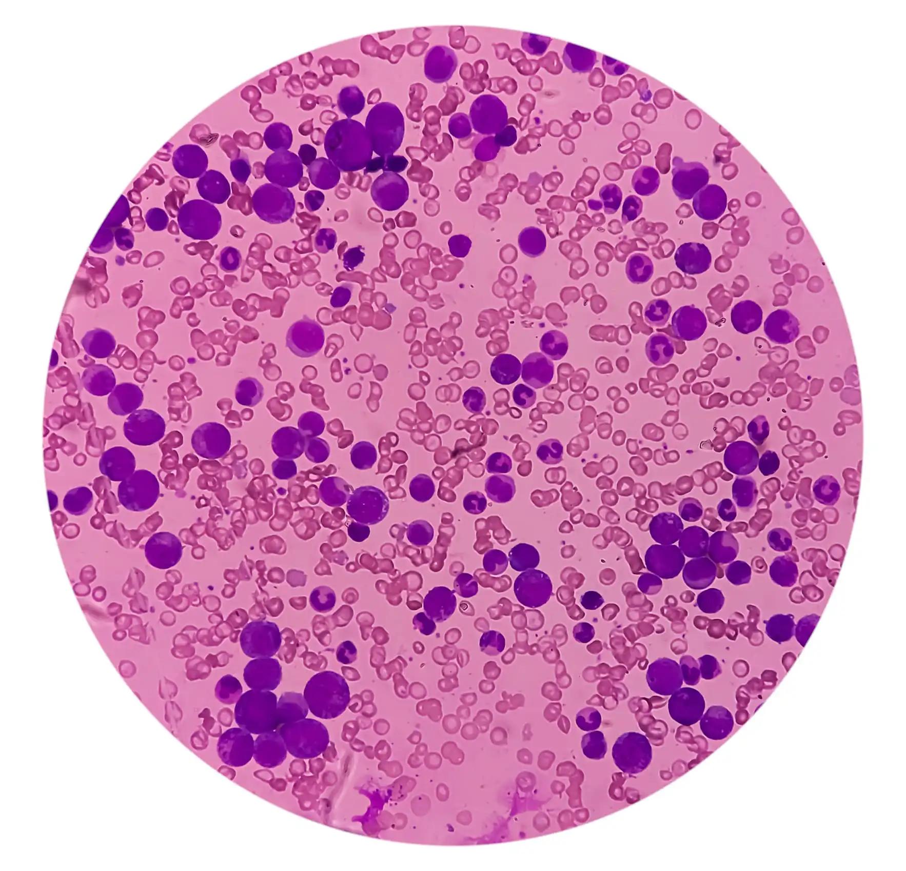Chronic Myeloid Leukemia Microcytic Hypochromic Anemia