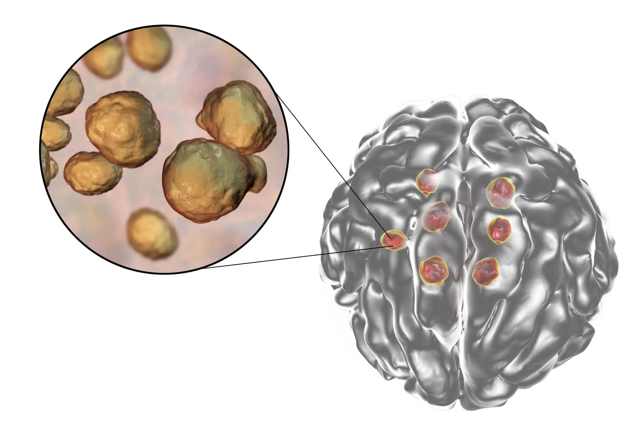 Cryptococcal Lesions in the Brain