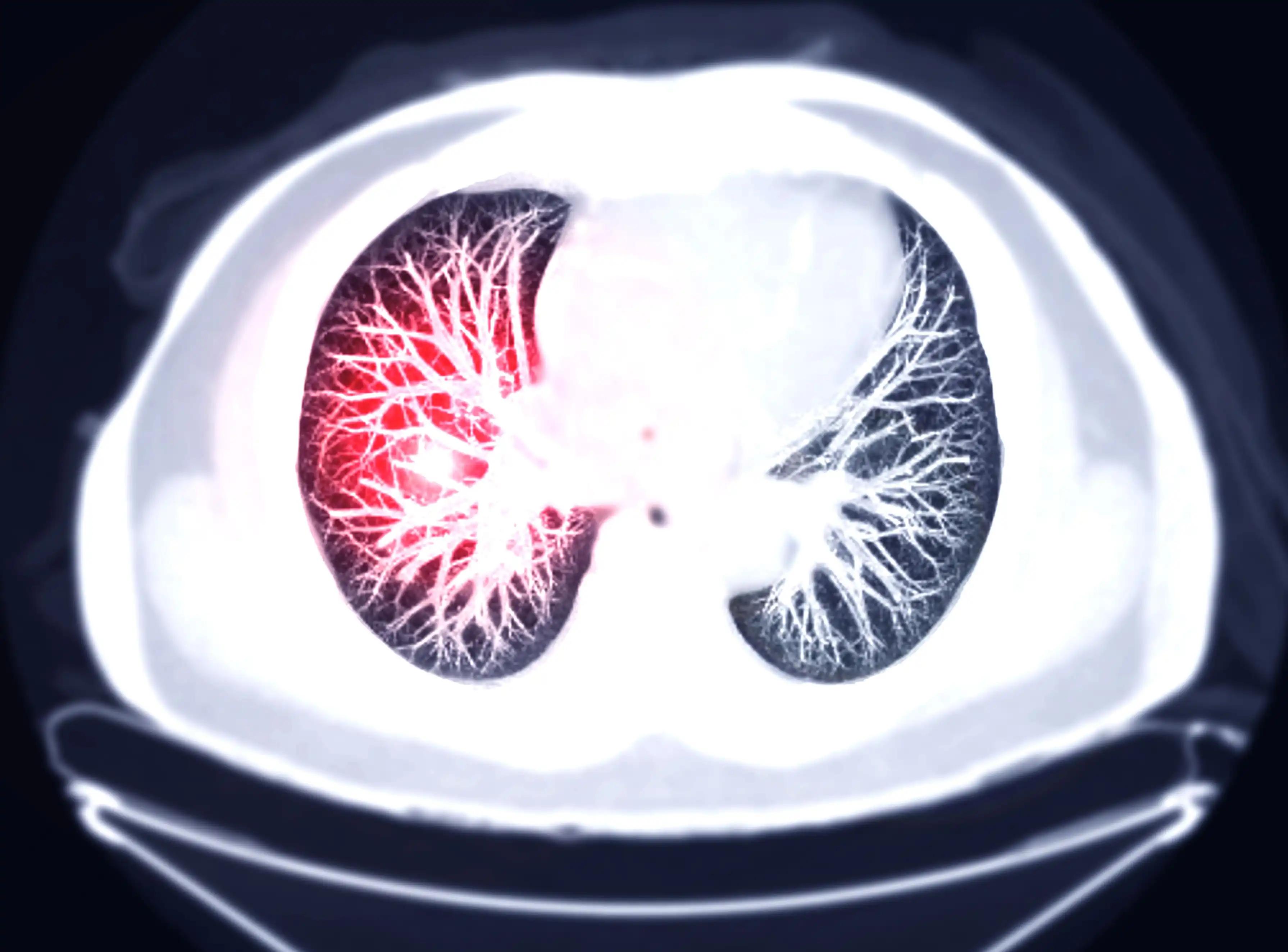 CT Chest AXIAL MIP View for Diagnostic Pulmonary Embolism
