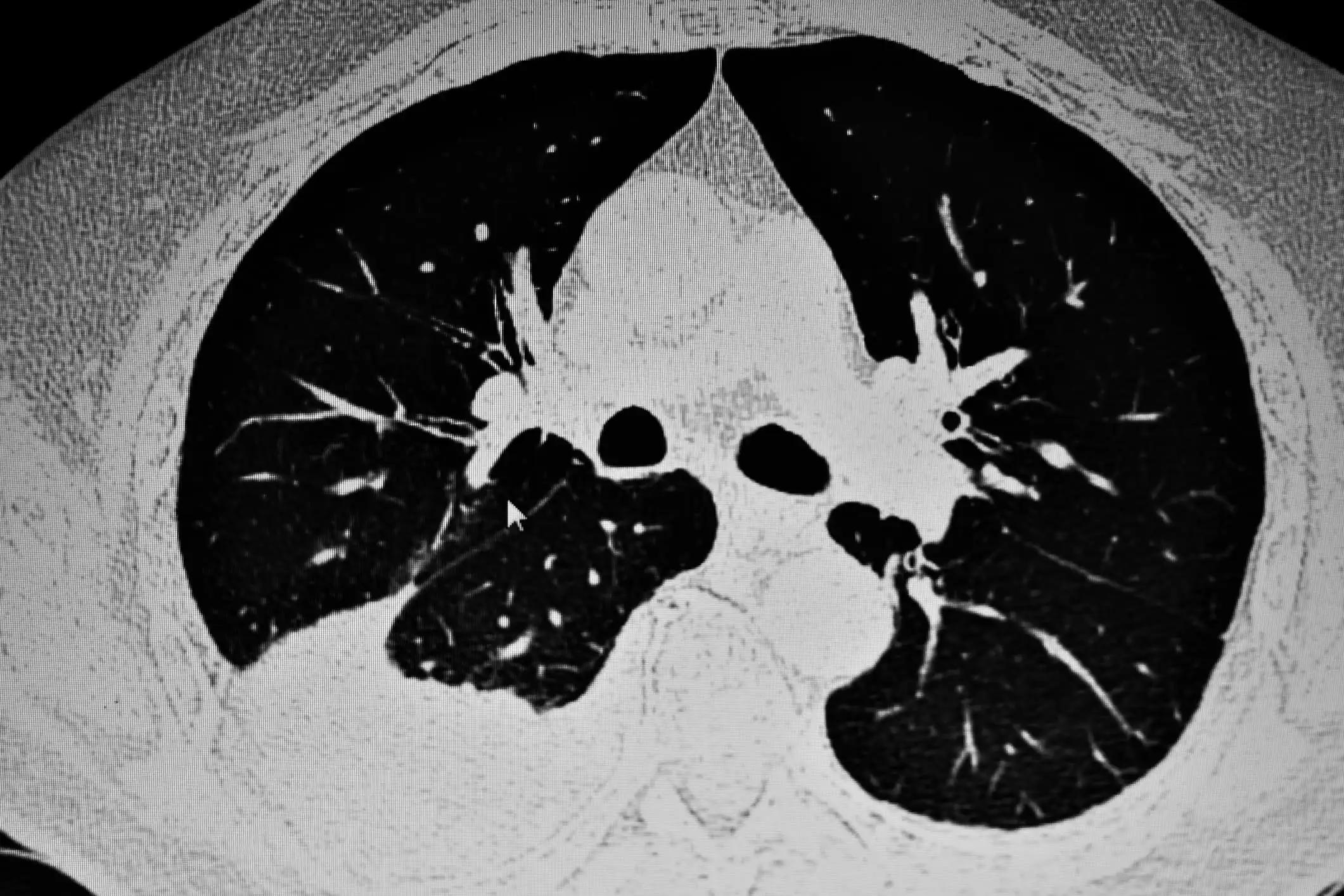 CT Scan of Non-Small Cell Lung Cancer Patients