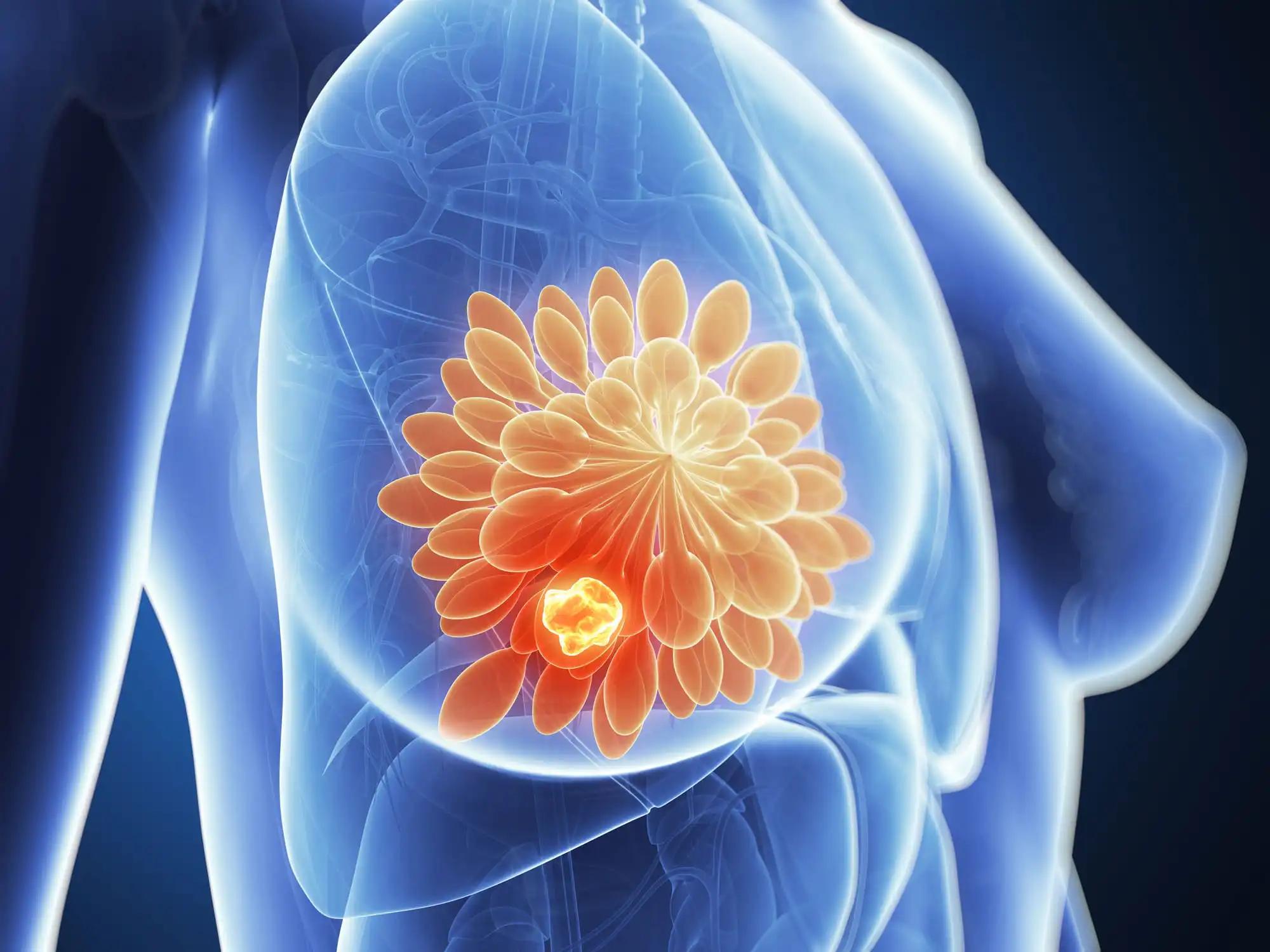 Deruxtecan vs Trastuzumab Metastatic Breast Cancer