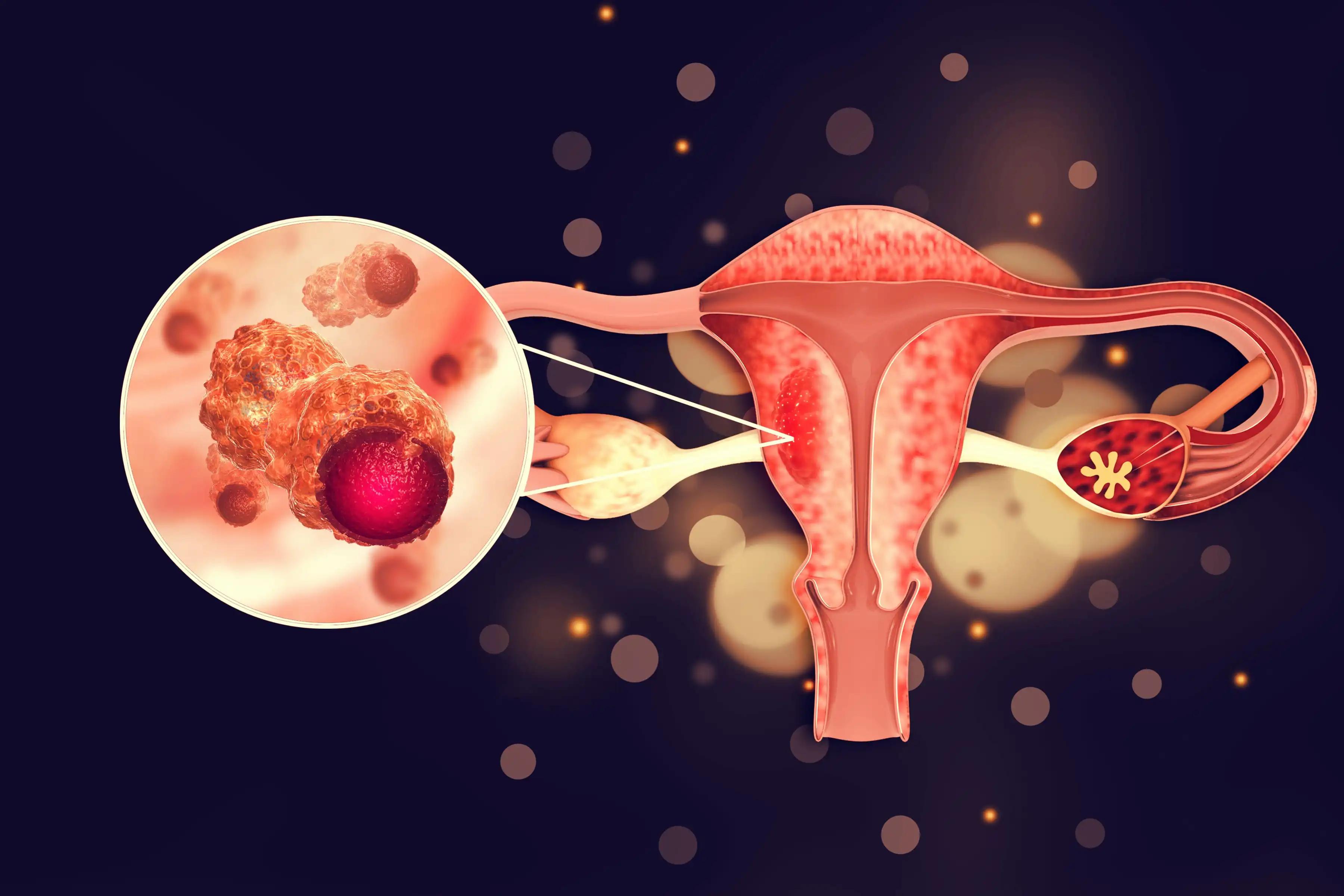 Endometrial Malignant Tumor as Uterine Medical Concept
