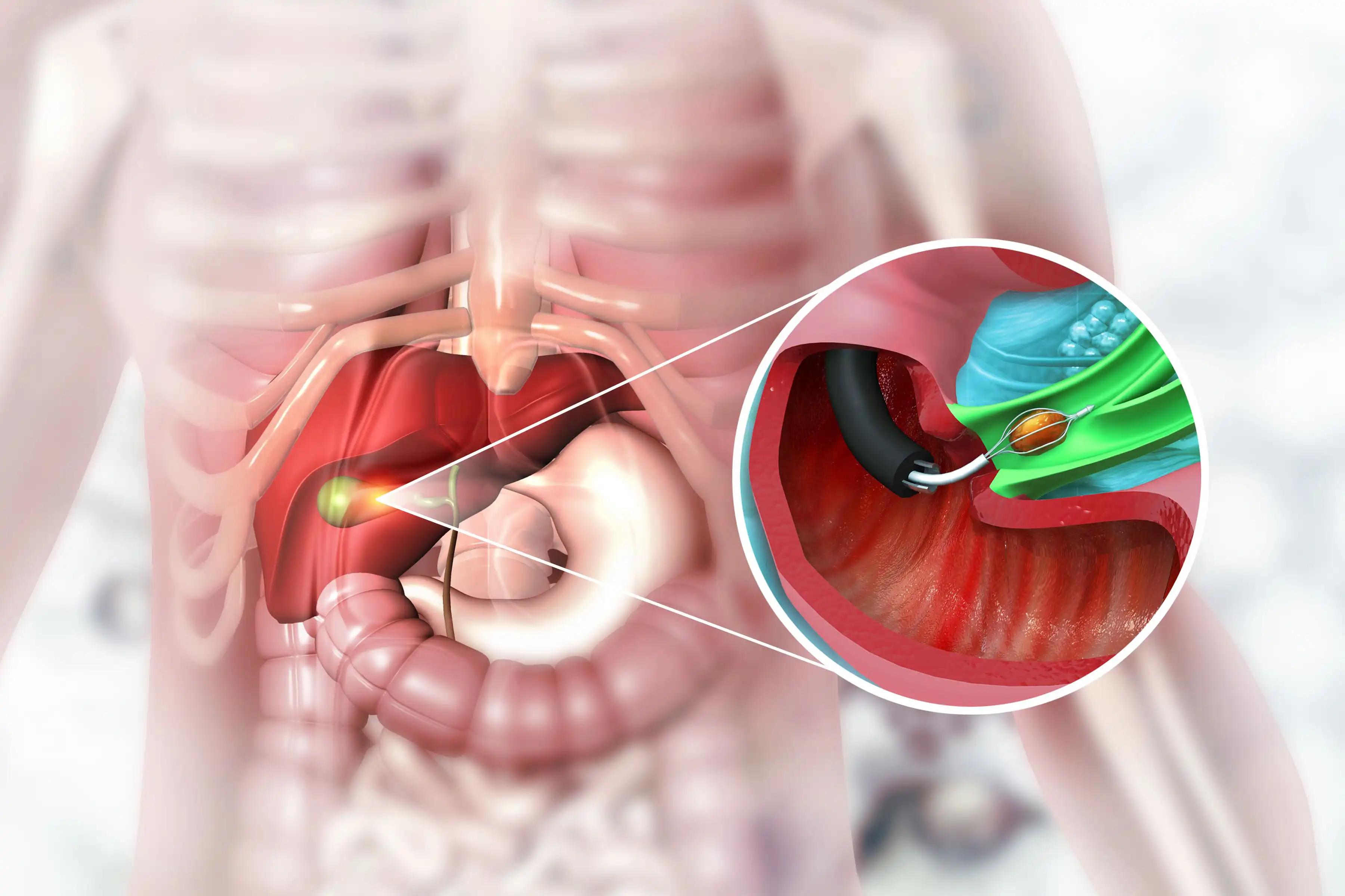 Gallstones Removing in the Gallbladder