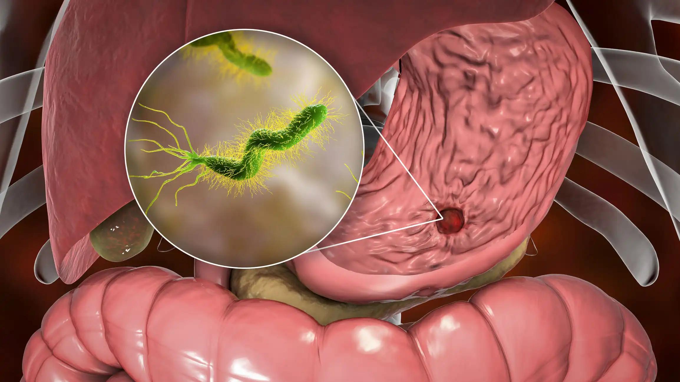 Gastric Ulcer and Helicobacter Pylori Bacteria in Stomach