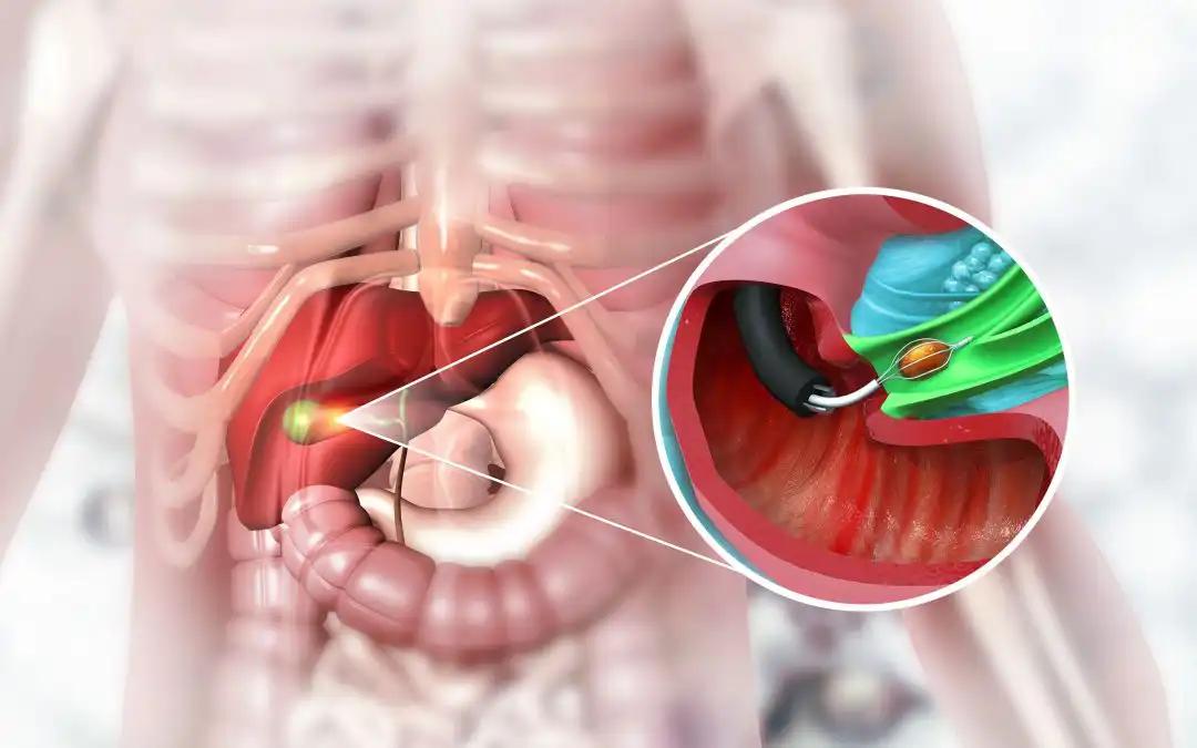 Long-Term RC and iON Survivors Report Better HRQoL Than Controls