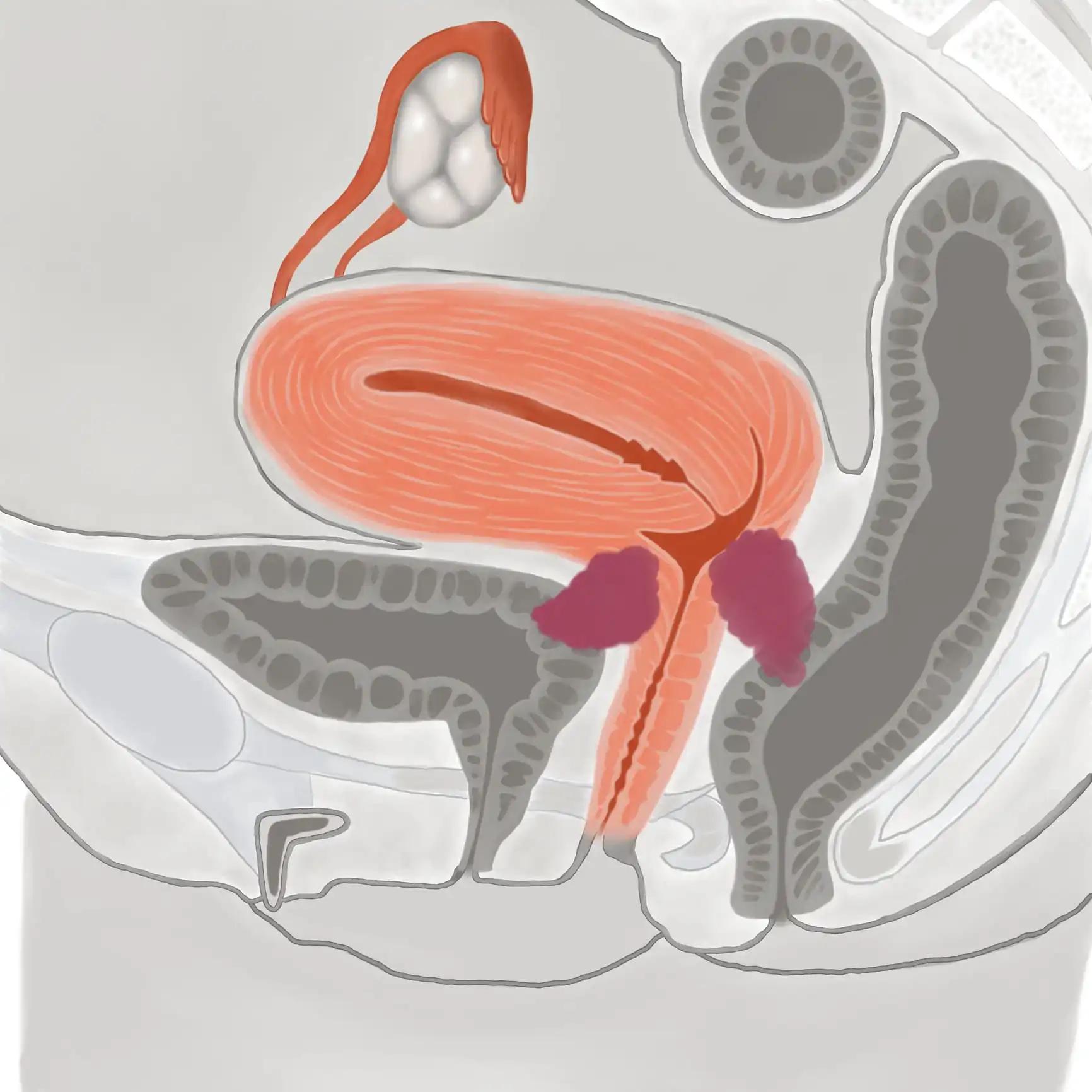 Illustration of Stage ⅣB Cervical Cancer