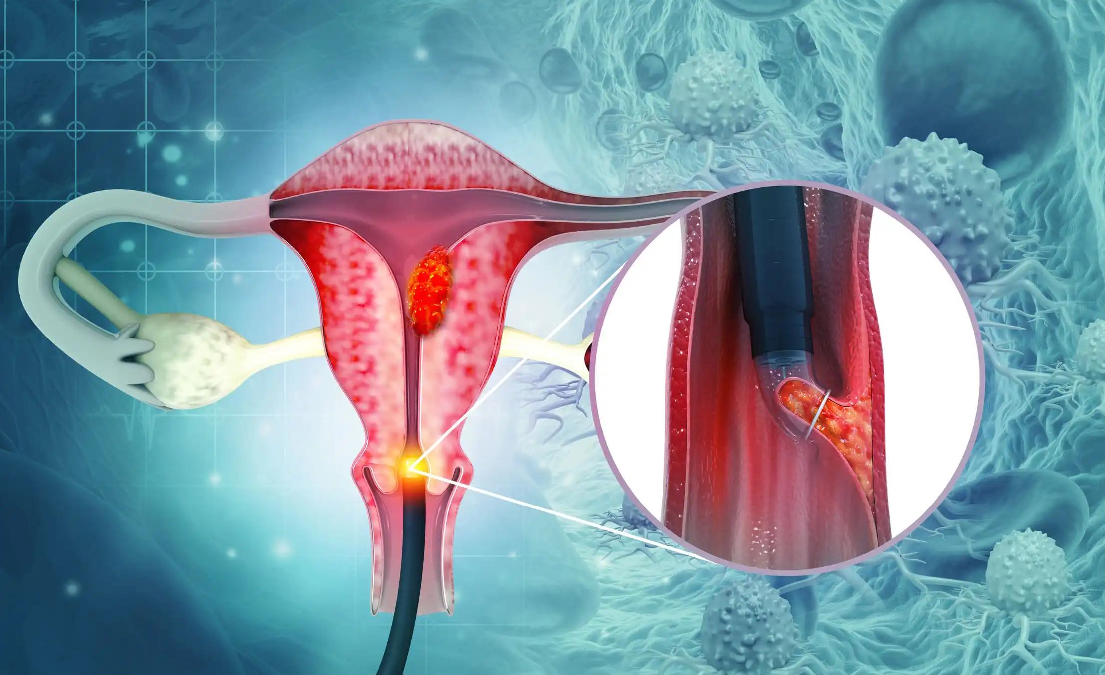 BTN3A1 Drives Vγ9Vδ2 T Cell Exhaustion in Cervical Cancer