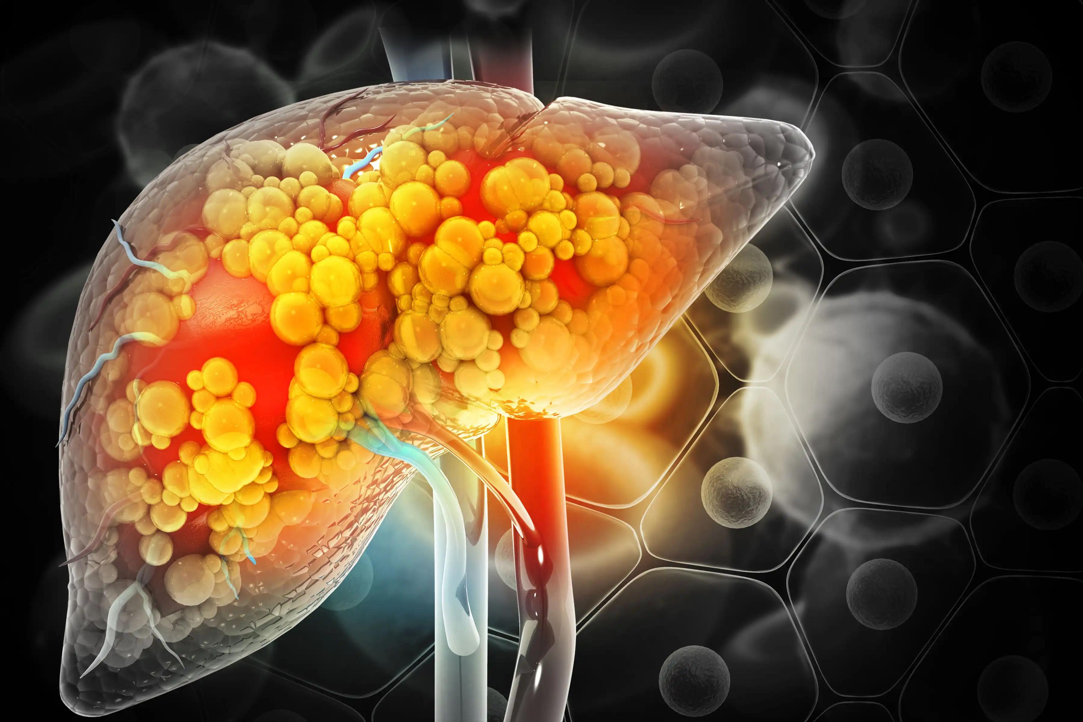 Lipid Metabolism in Liver Cancer