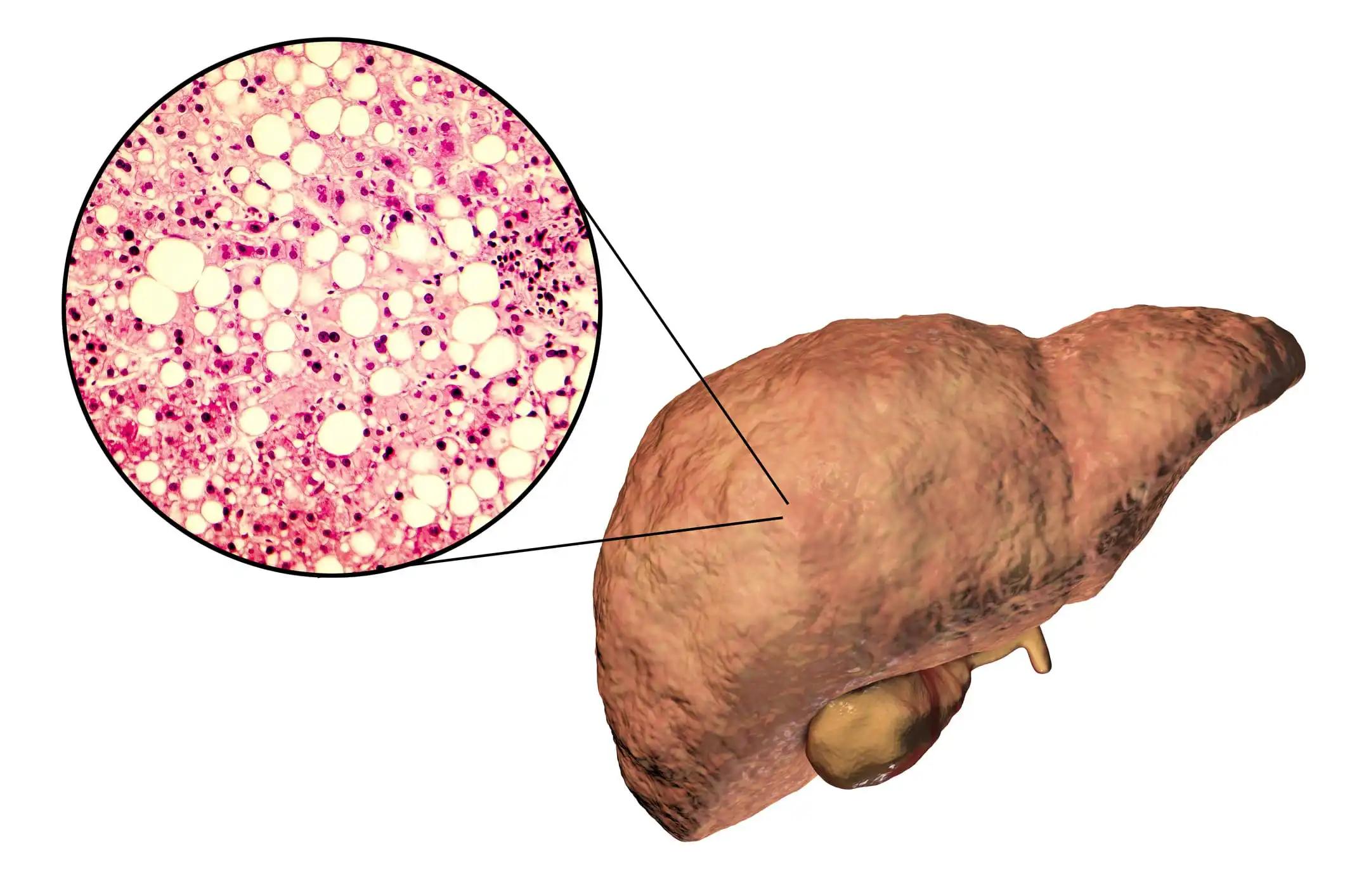 Liver Fibrosis Chronic Liver Diseases