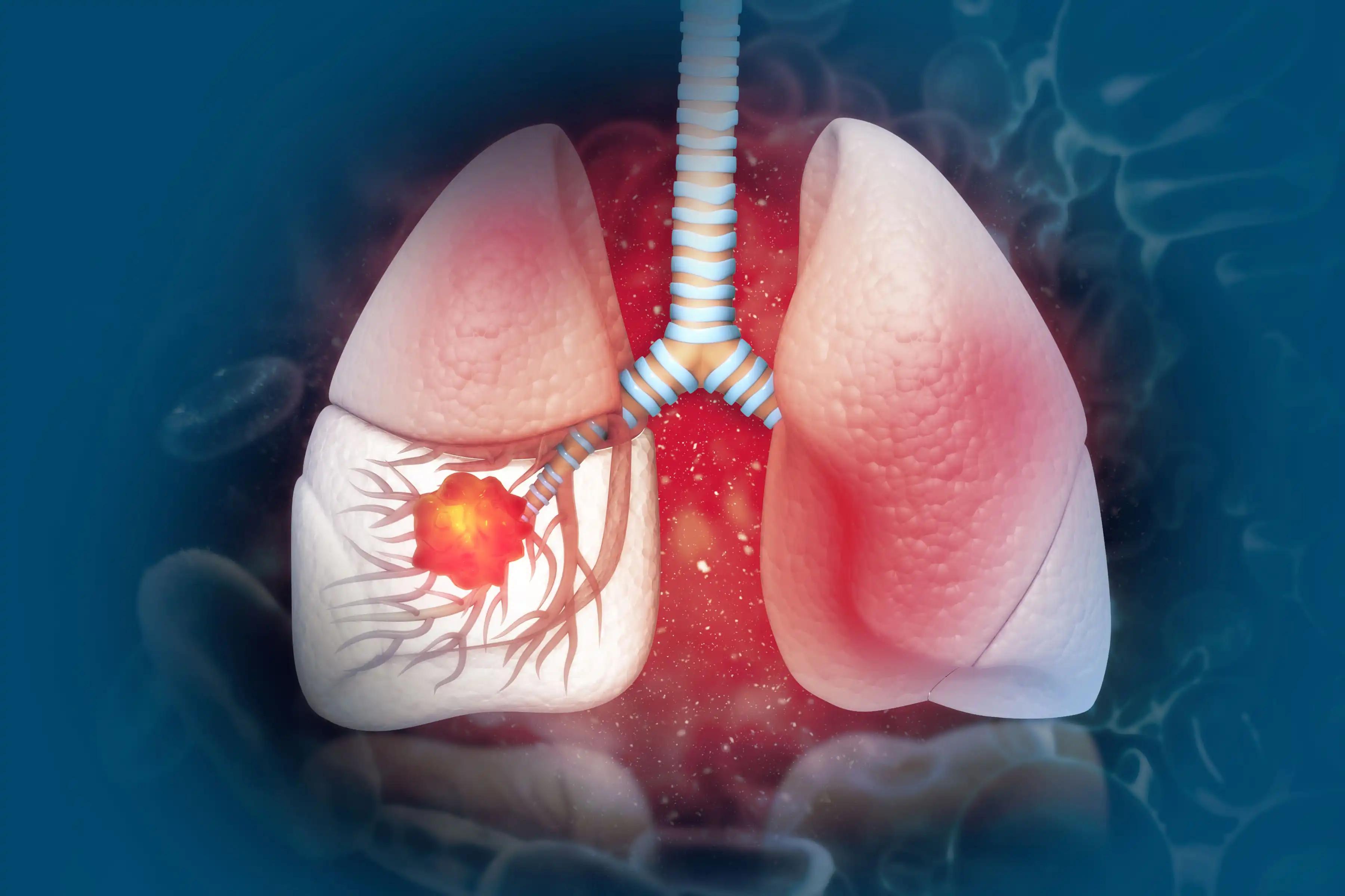 Lung Cancer Treatment Inhibitor Combo in a NSCLC