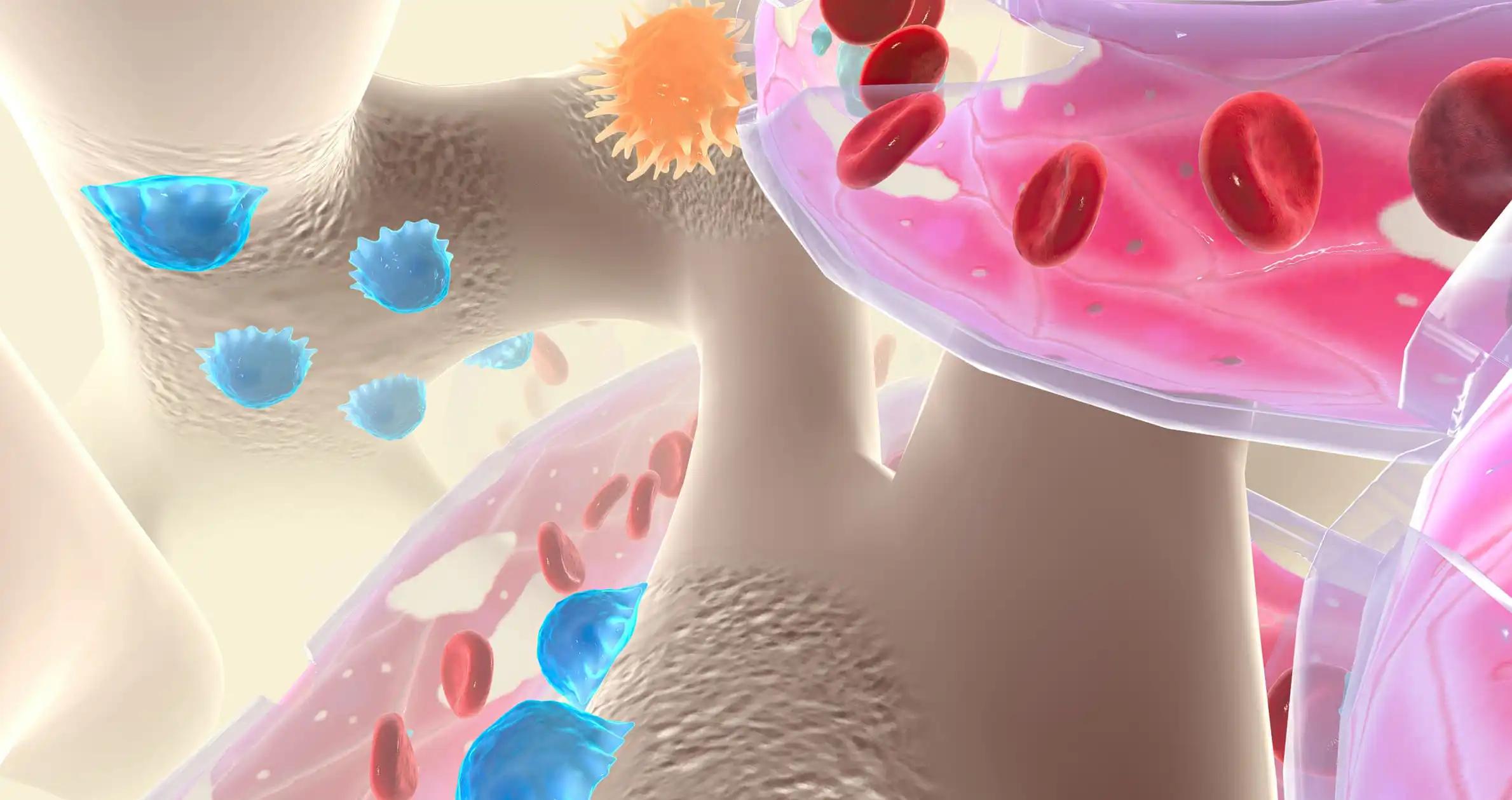 Lymphoblasts Invaded Bone Marrow Production of Blood Cells