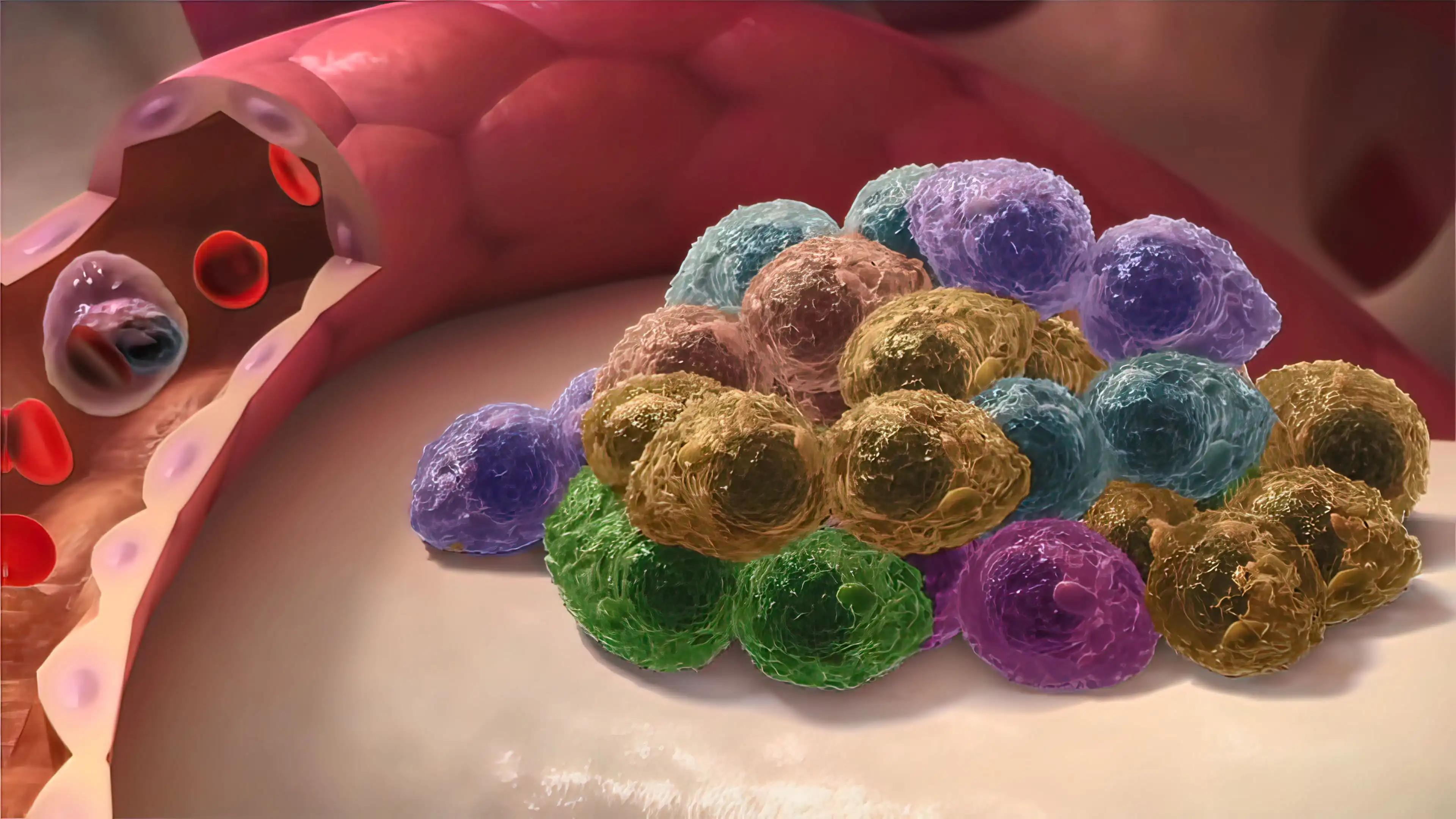 Lymphoma Cancer Affecting Blood Cells