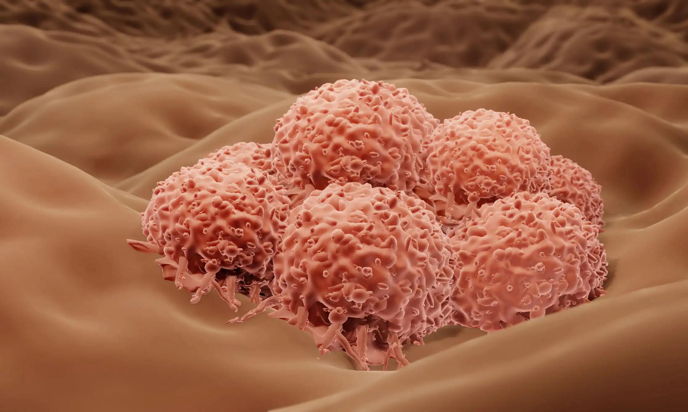Melanoma Skin Cancer Cells