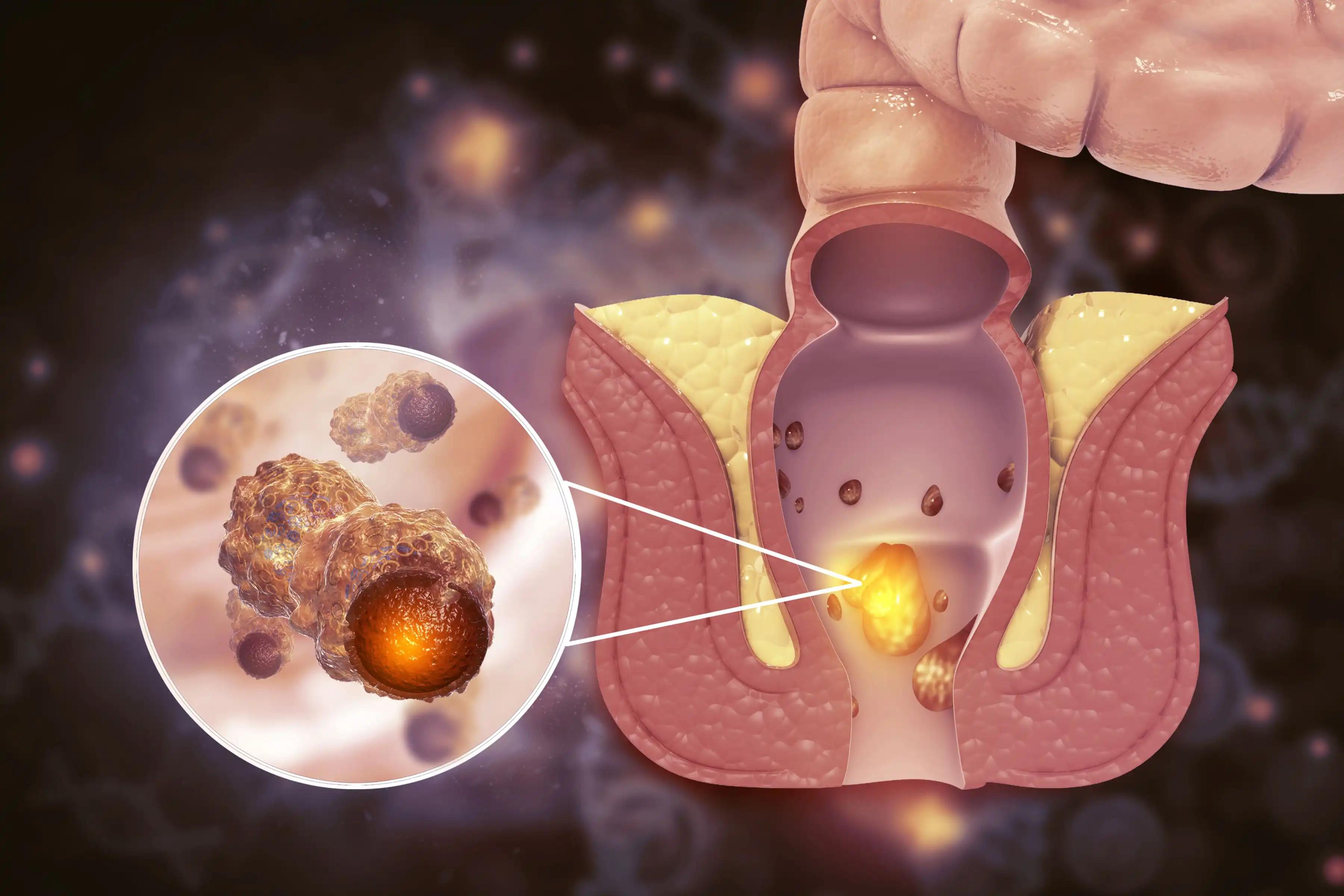 Platinum-Sensitive Relapsed Ovarian Cancer Virus