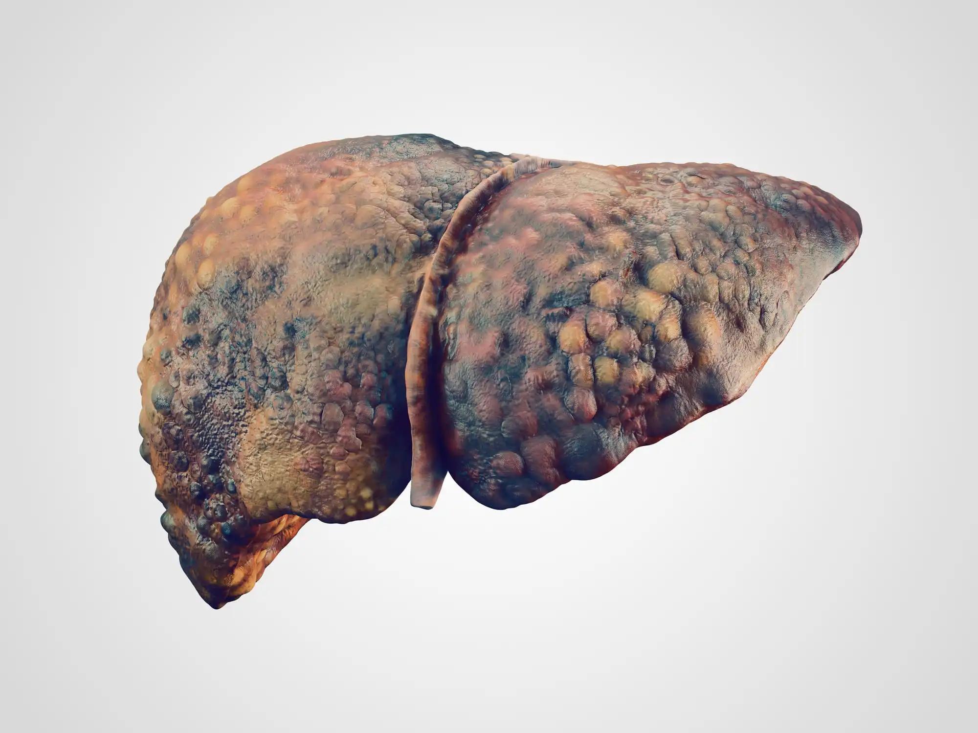 Realistic Illustration of Cirrhosis of Liver