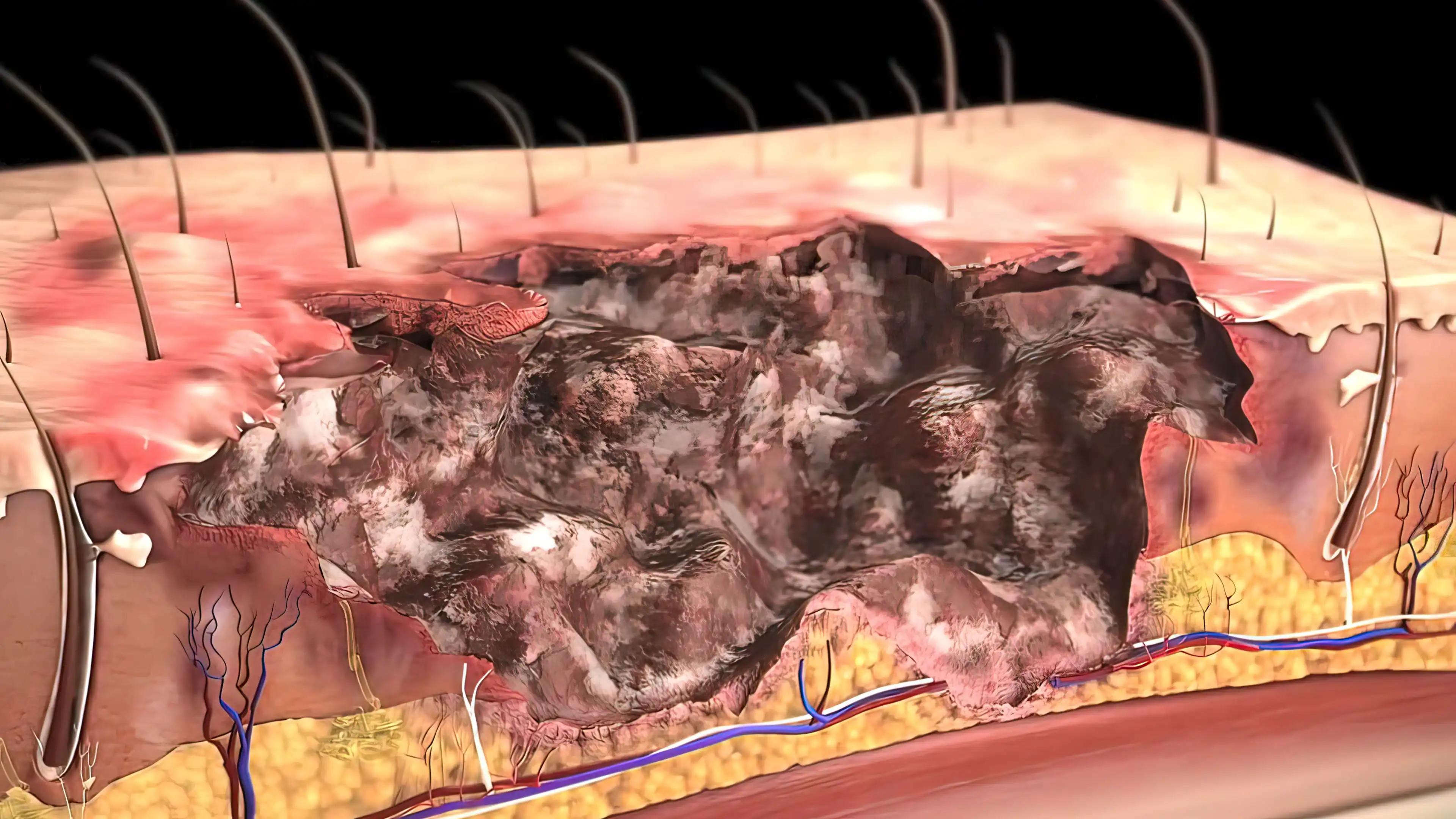 Squamous Cell Carcinoma Chemotherapy