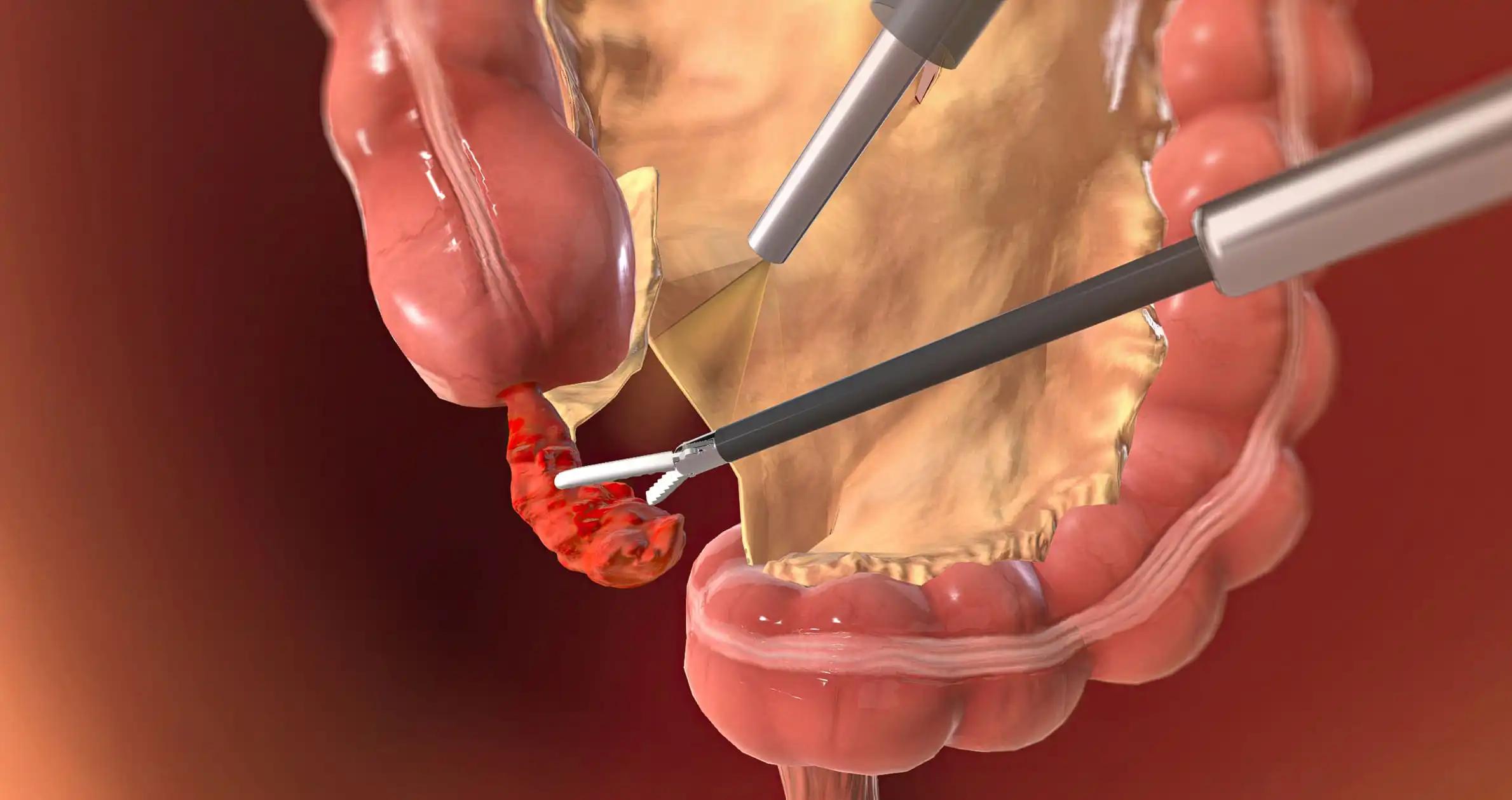 Treatment of Colorectal Cancer