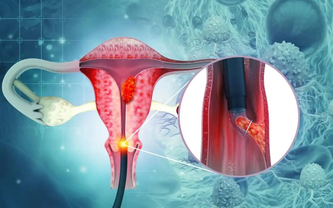 Role of ALOX5+ MCs in CC Progression